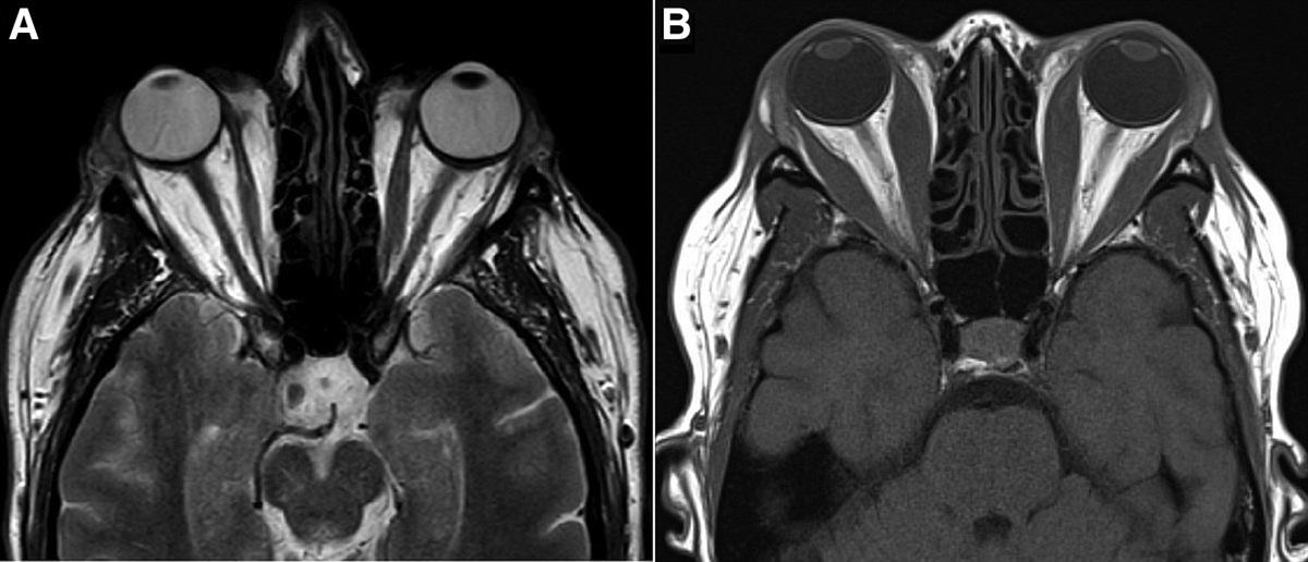 Dysthyroid Optic Neuropathy