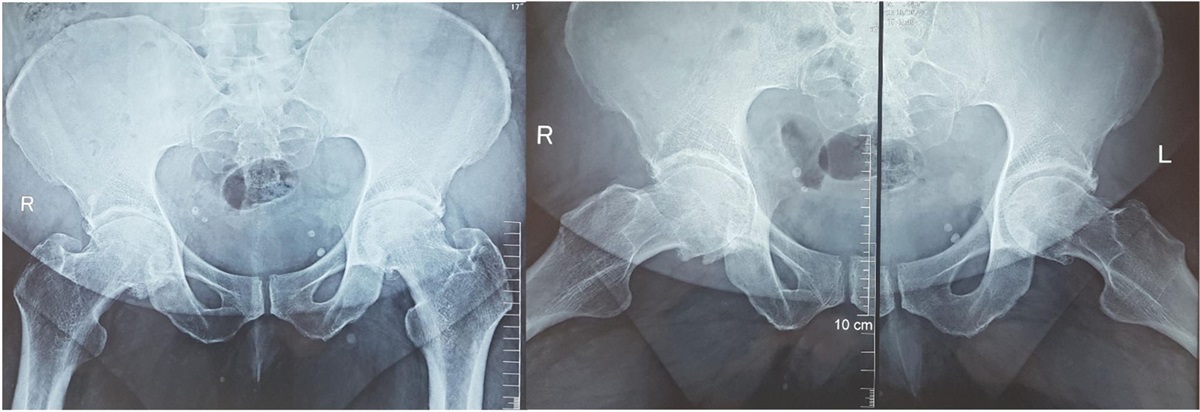Role of bilateral staged hip arthroplasty in Hip-spine syndrome: A case report