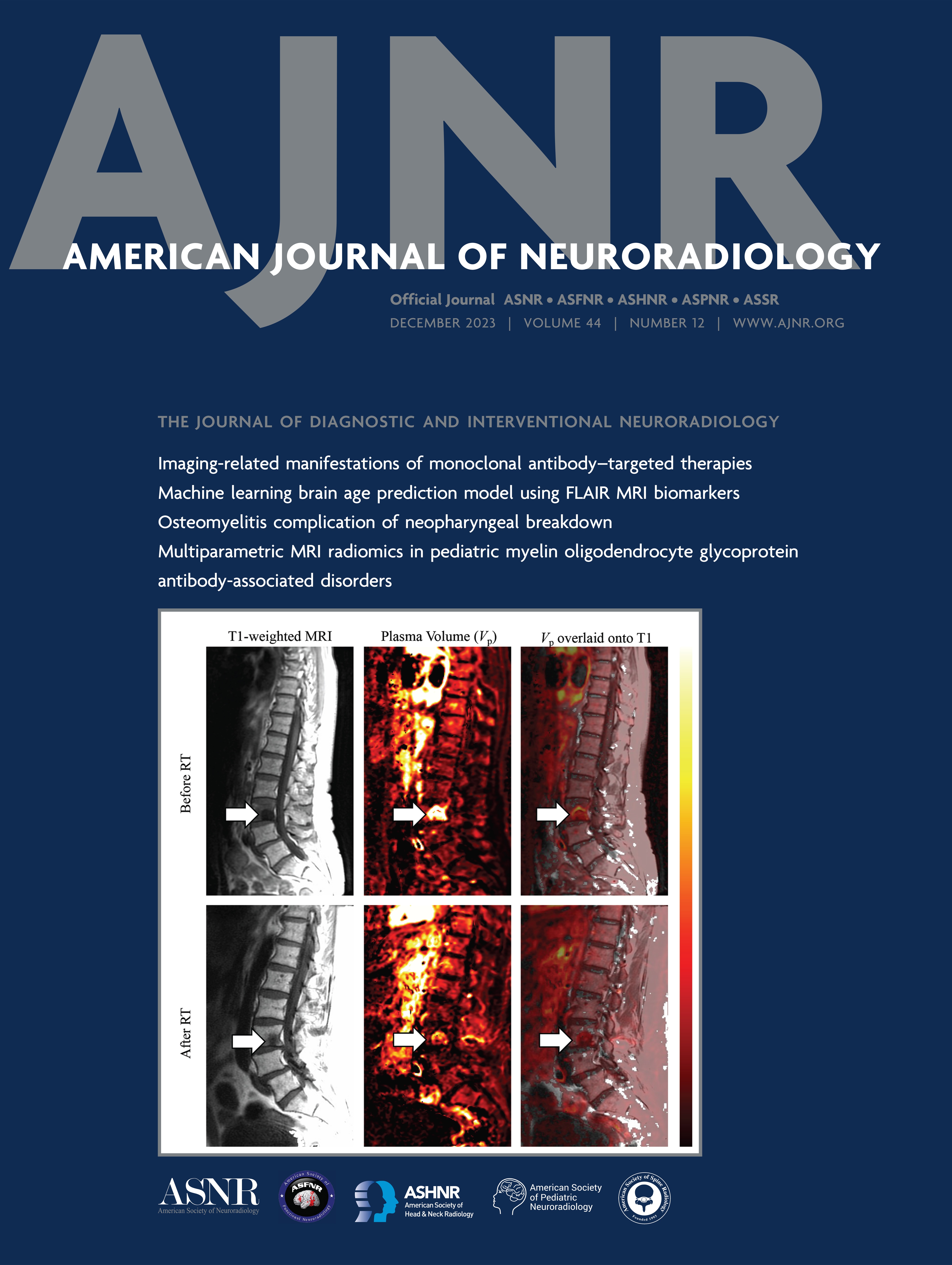 Cervical Osteomyelitis and Diskitis as a Complication of Neopharyngeal Breakdown: A Multisite Case Series Review [HEAD AND NECK IMAGING]