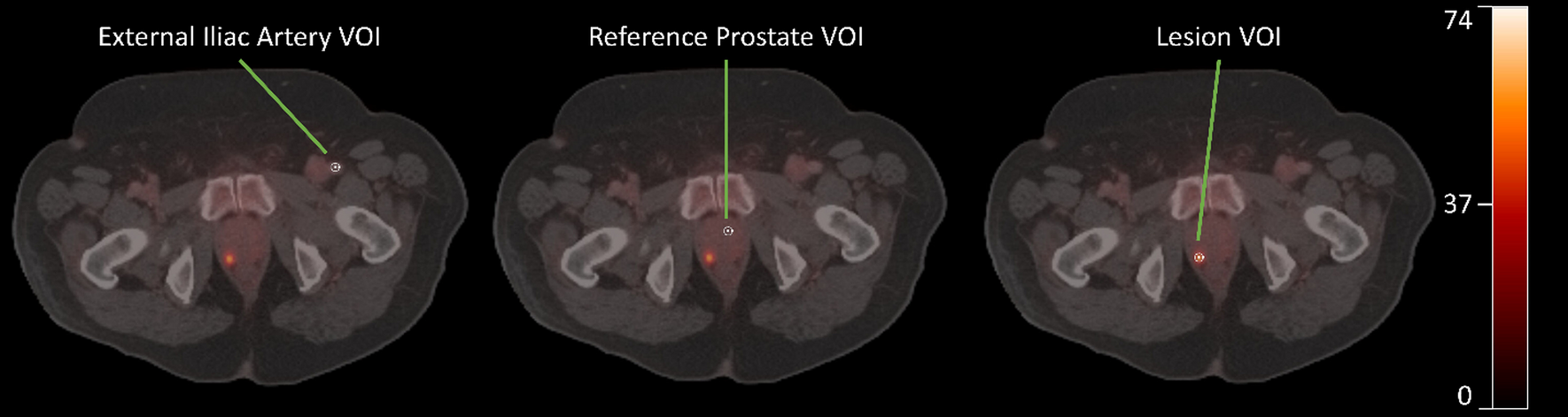 Comparison of tracer kinetic models for 68Ga-PSMA-11 PET in intermediate-risk primary prostate cancer patients