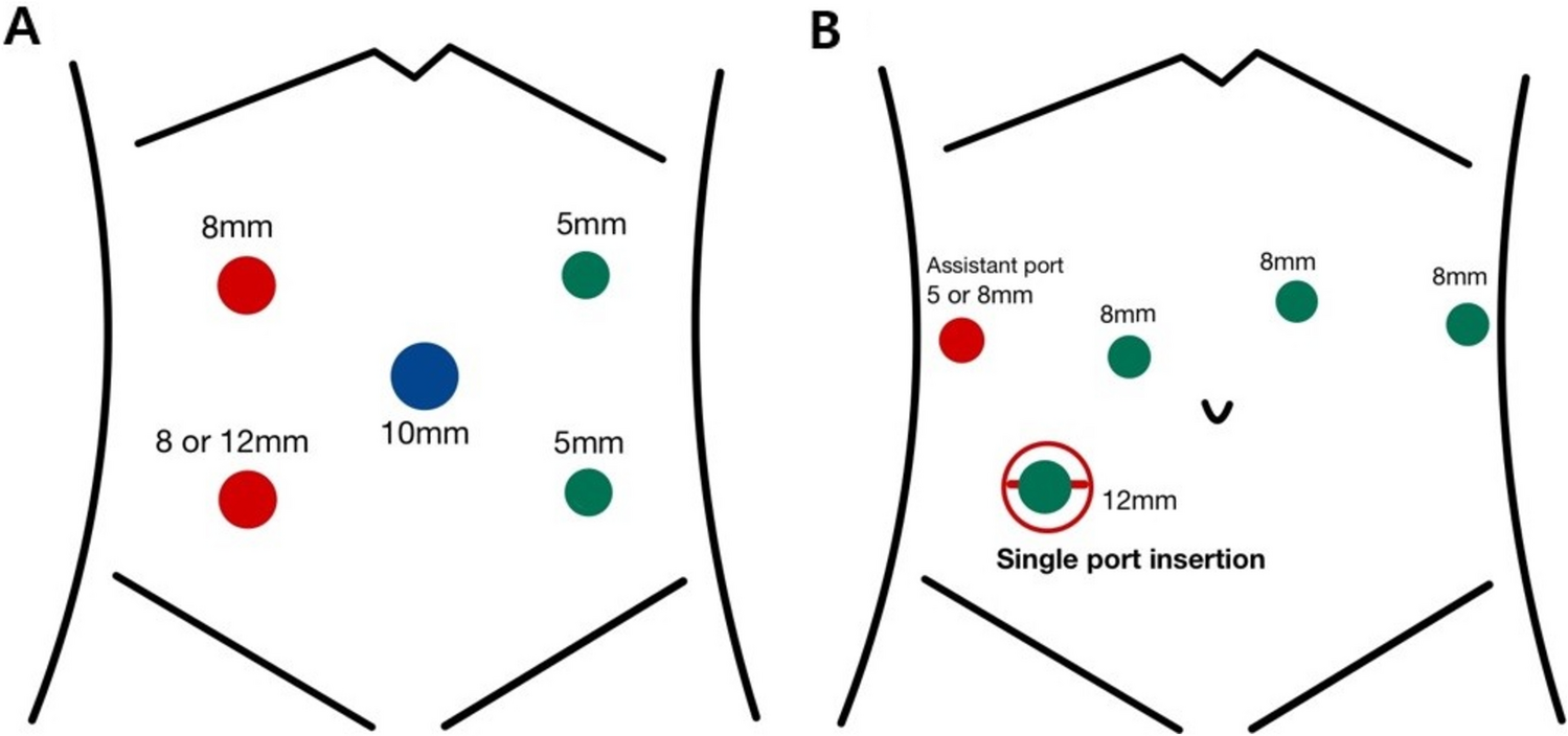 Perioperative outcomes of laparoscopic low anterior resection using ArtiSential® versus robotic approach in patients with rectal cancer: a propensity score matching analysis