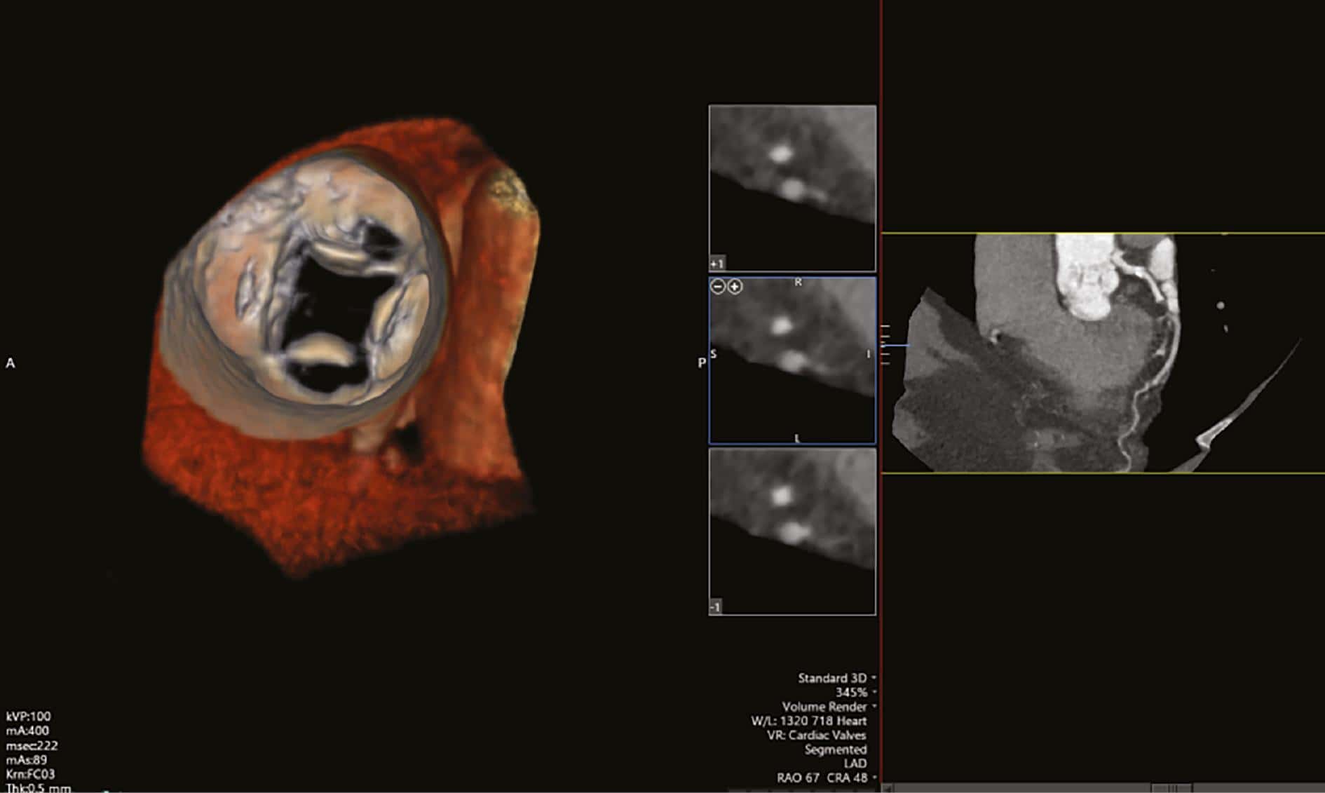 Quadricuspid Aortic Valve: A Rare Congenital Anomaly Presenting in Adulthood with Severe Aortic Regurgitation