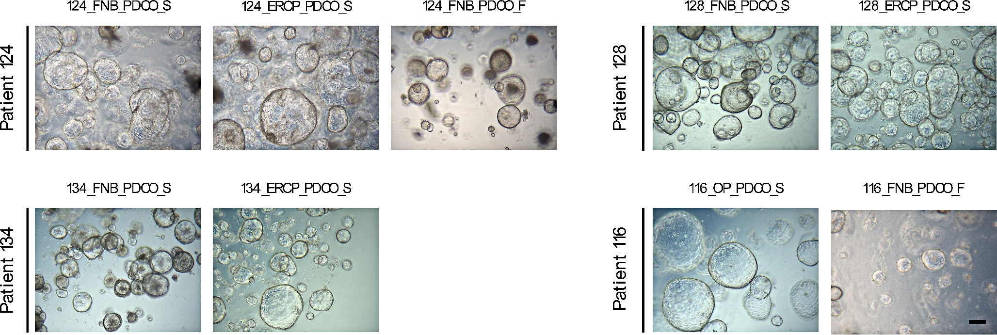 The origin of patient-derived cancer organoids from pathologically undiagnosed specimen in patients with pancreatobiliary cancers