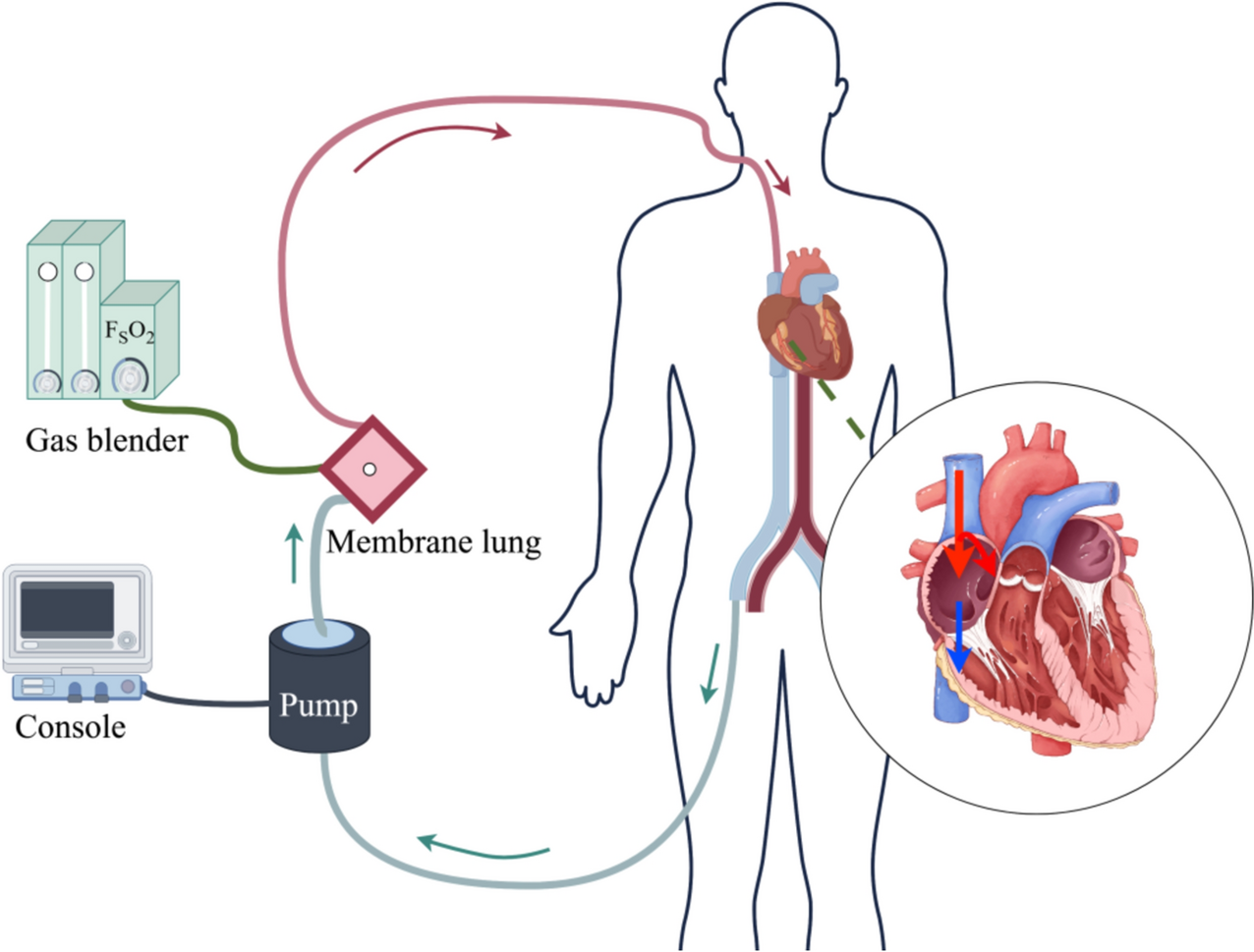 ECMO for bridging lung transplantation