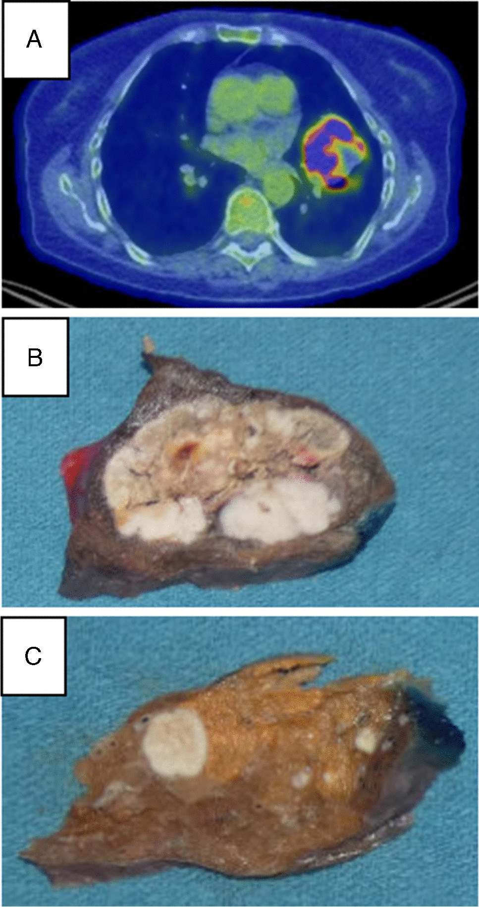 YAP1::TFE3 fusion in a case of malignant TFE3-rearranged PEComa of the lung: expanding the spectrum of pulmonary PEComa-like mesenchymal neoplasms