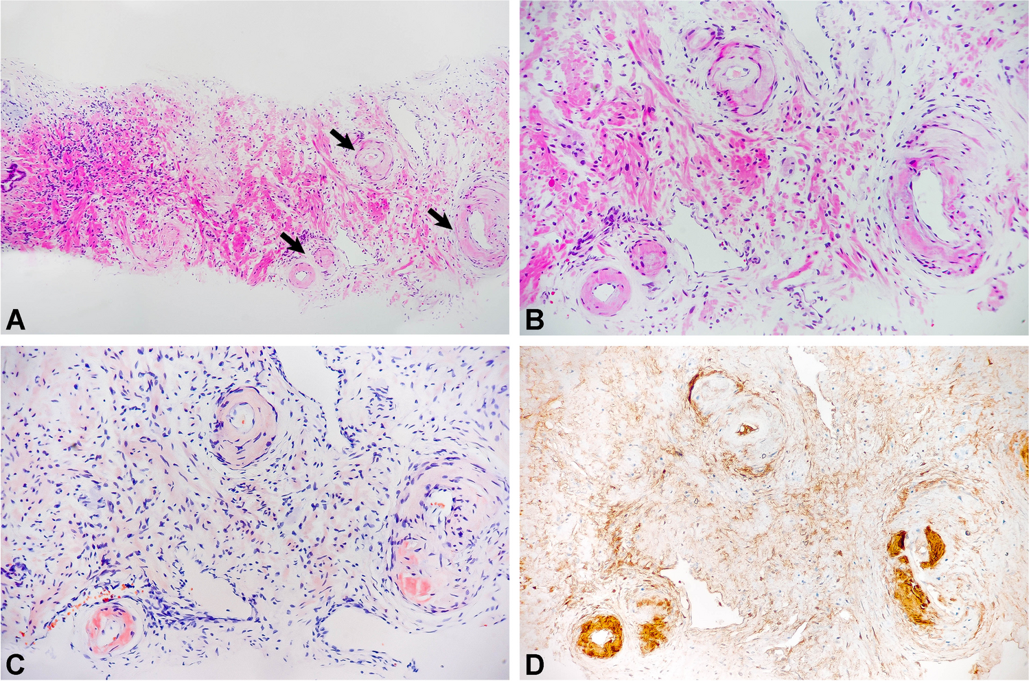 Prostatic amyloidosis: pathological features of an underdiagnosed condition