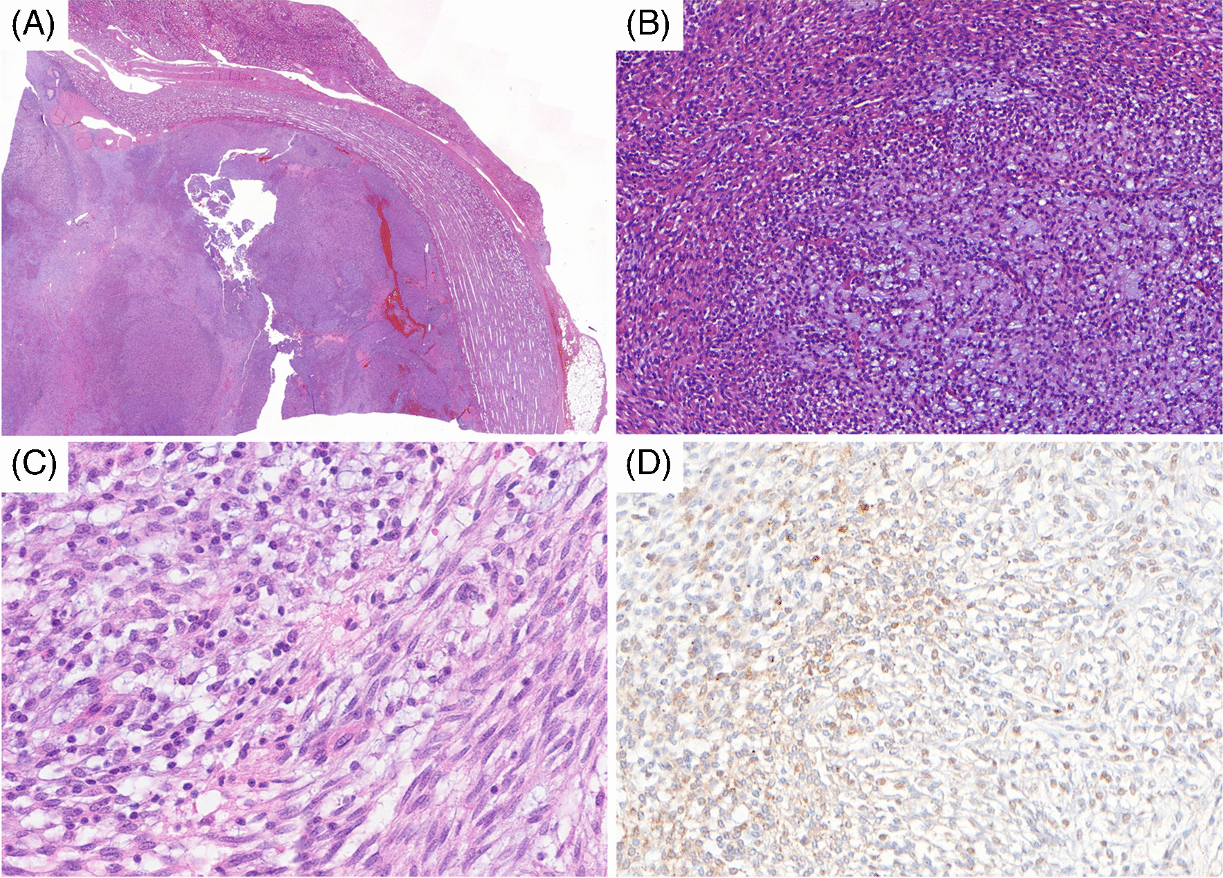 GLI1::FOXO4-rearranged kidney tumors: a potentially distinct renal subtype within the spectrum of GLI1-altered tumors?