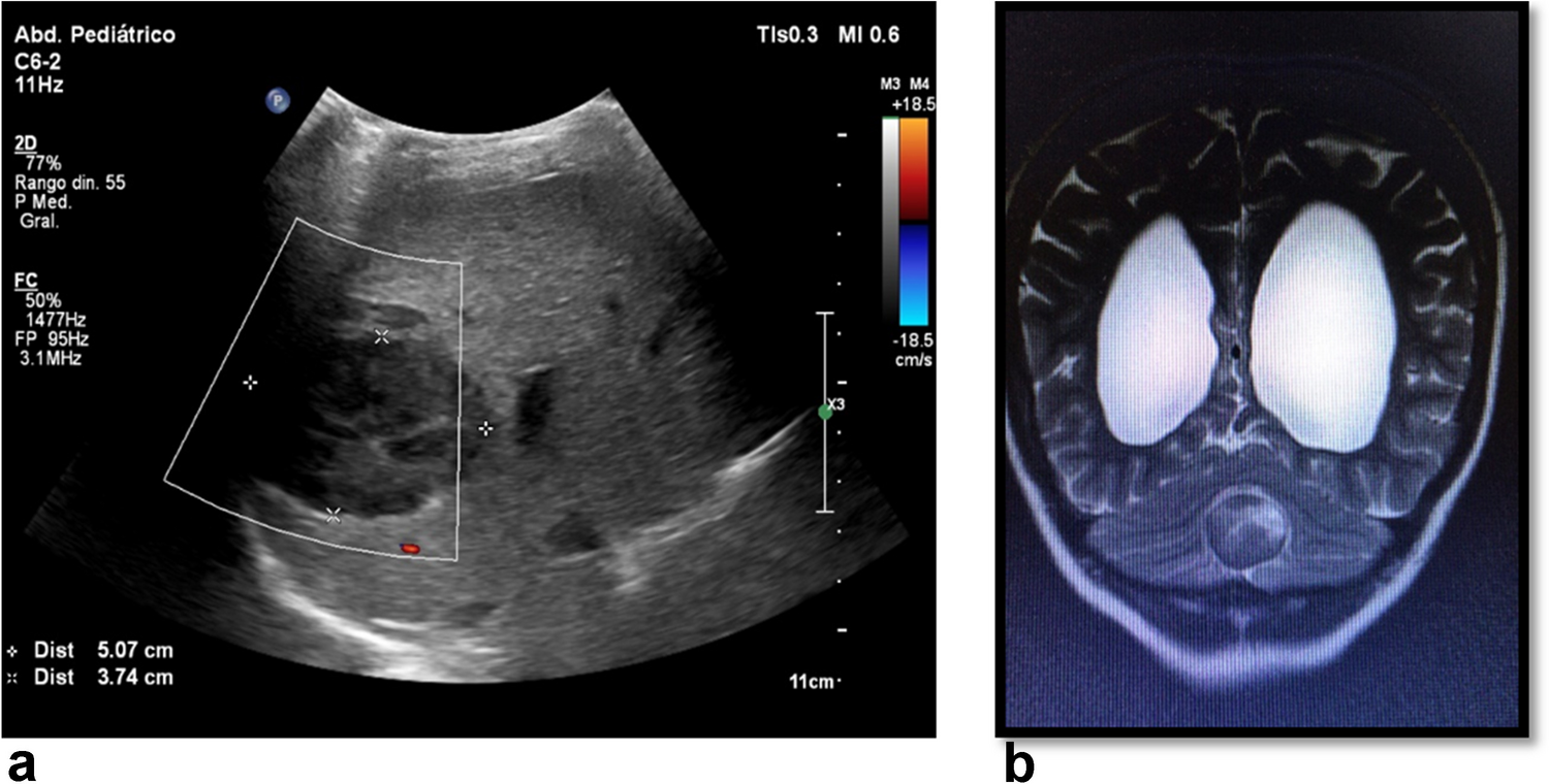 Epstein-Barr virus-associated post-transplant smooth muscle tumours in a kidney transplant patient