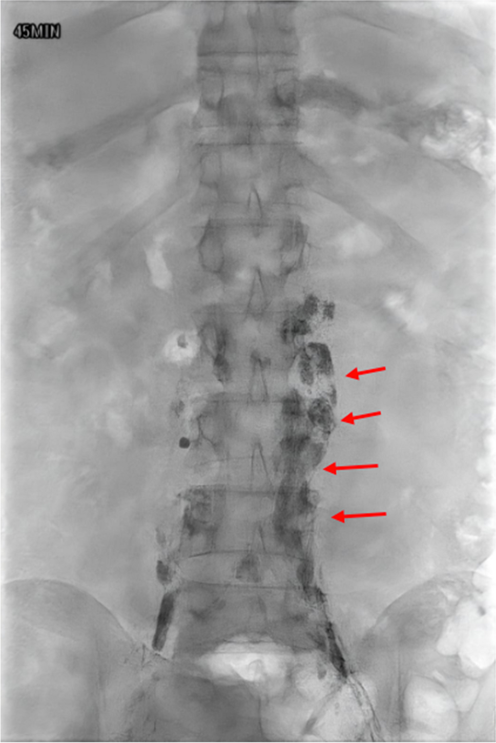 Lymphangiogram in primary intestinal lymphangiectasia
