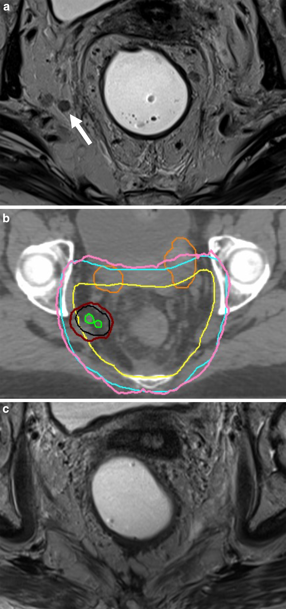 Simultaneous integrated boost to lateral pelvic lymph nodes during chemoradiotherapy in high-risk rectal cancer