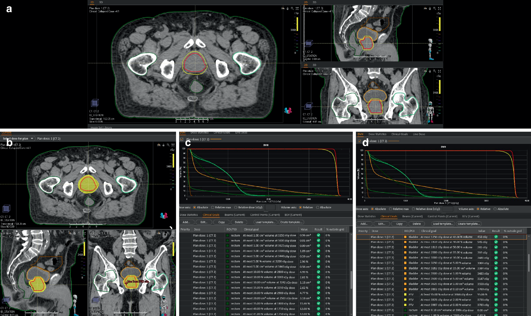 Predicting acute and late toxicity in prostate cancer stereotactic ablative radiotherapy: the role of dosimetric parameters and prostate volume