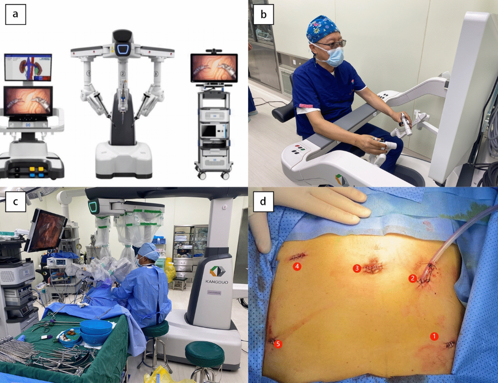 Clinical application of the KangDuo-Surgical Robot-01 in distal gastrectomy for gastric cancer