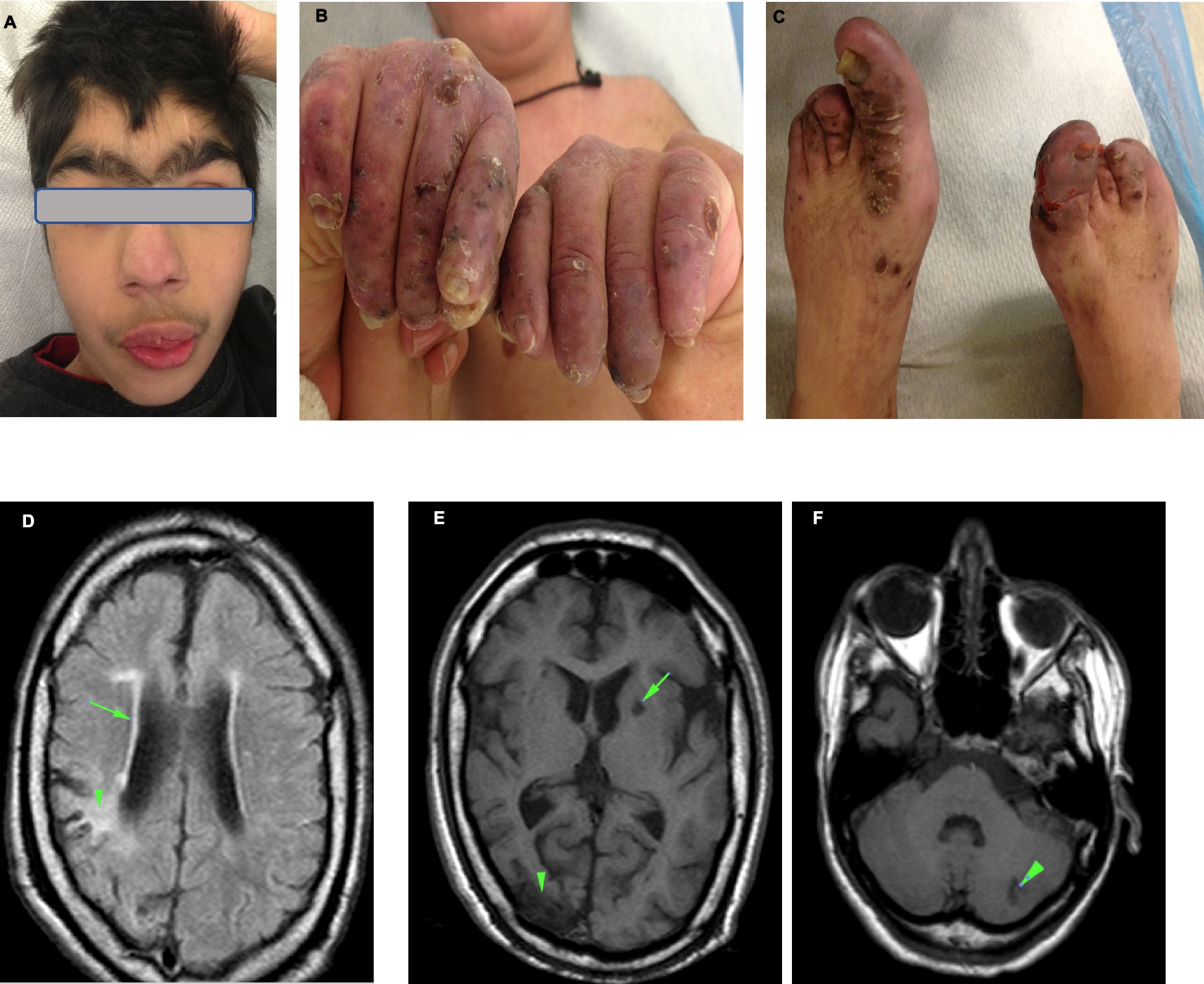 Increased interferon I signaling, DNA damage response and evidence of T-cell exhaustion in a patient with combined interferonopathy (Aicardi-Goutières Syndrome, AGS) and cohesinopathy (Cornelia de Lange Syndrome, CdLS)