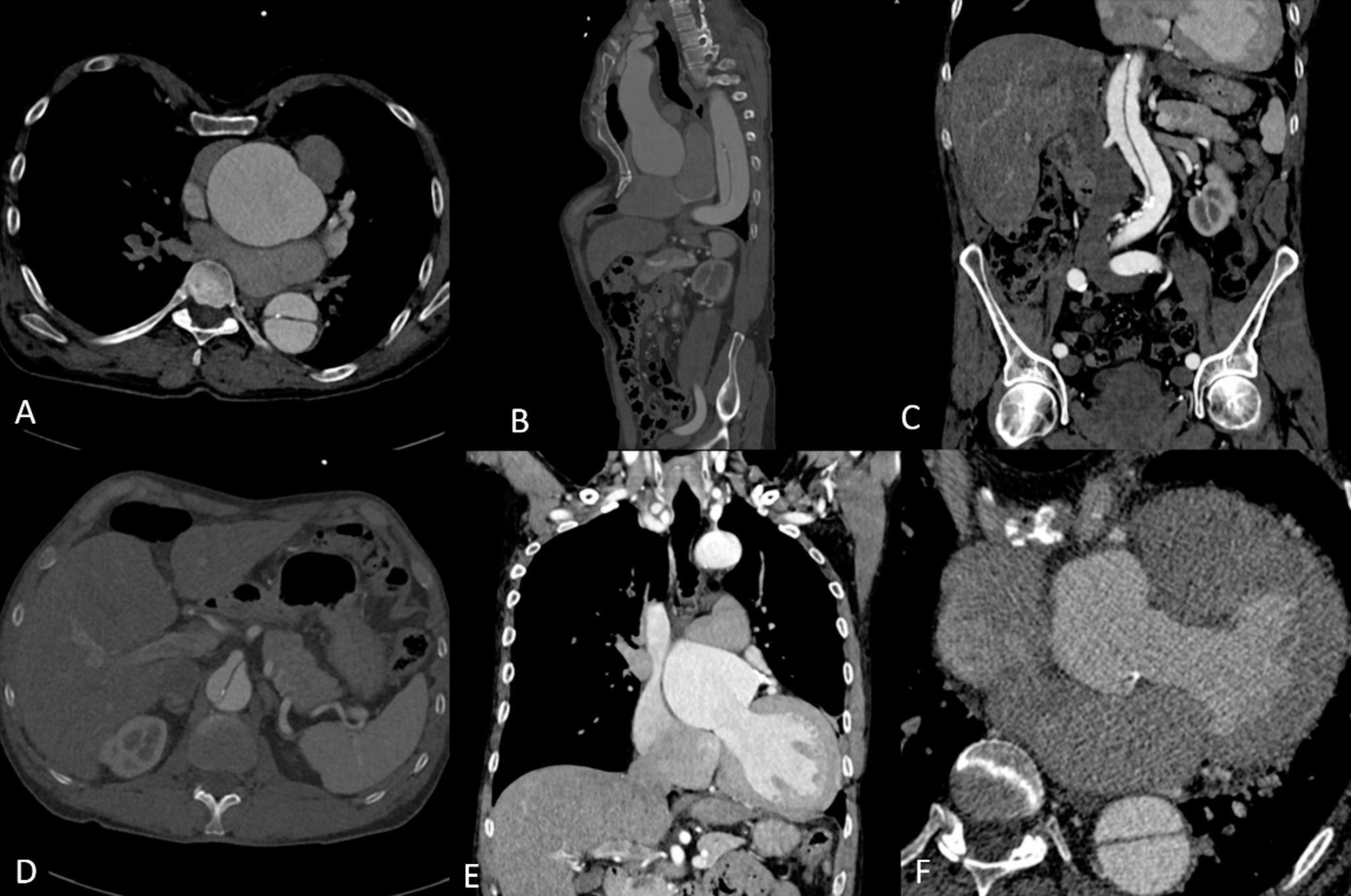 CT angiography of acute aortic syndrome in patients with chronic kidney disease