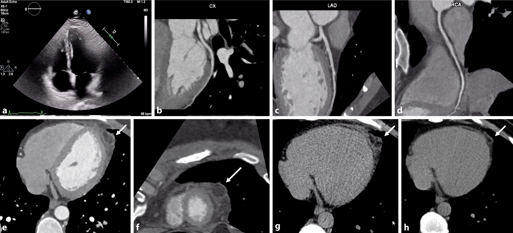 A twisted diagnosis of chest pain: the prominent role of coronary computed tomography