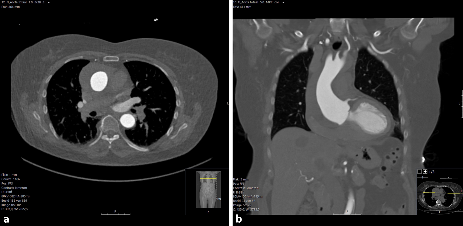 Sudden onset chest pain after a CT-scan of the aorta