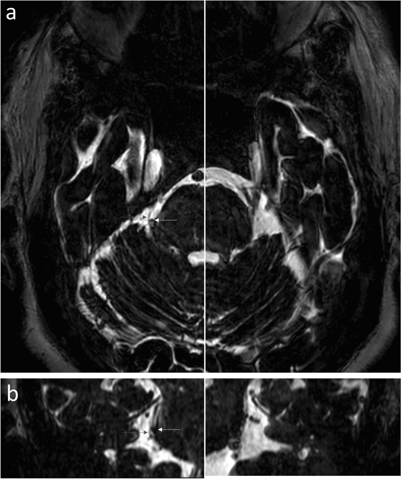 Trigeminal Neuralgia: Disease Characterization and Prediction of Response to Surgical Intervention