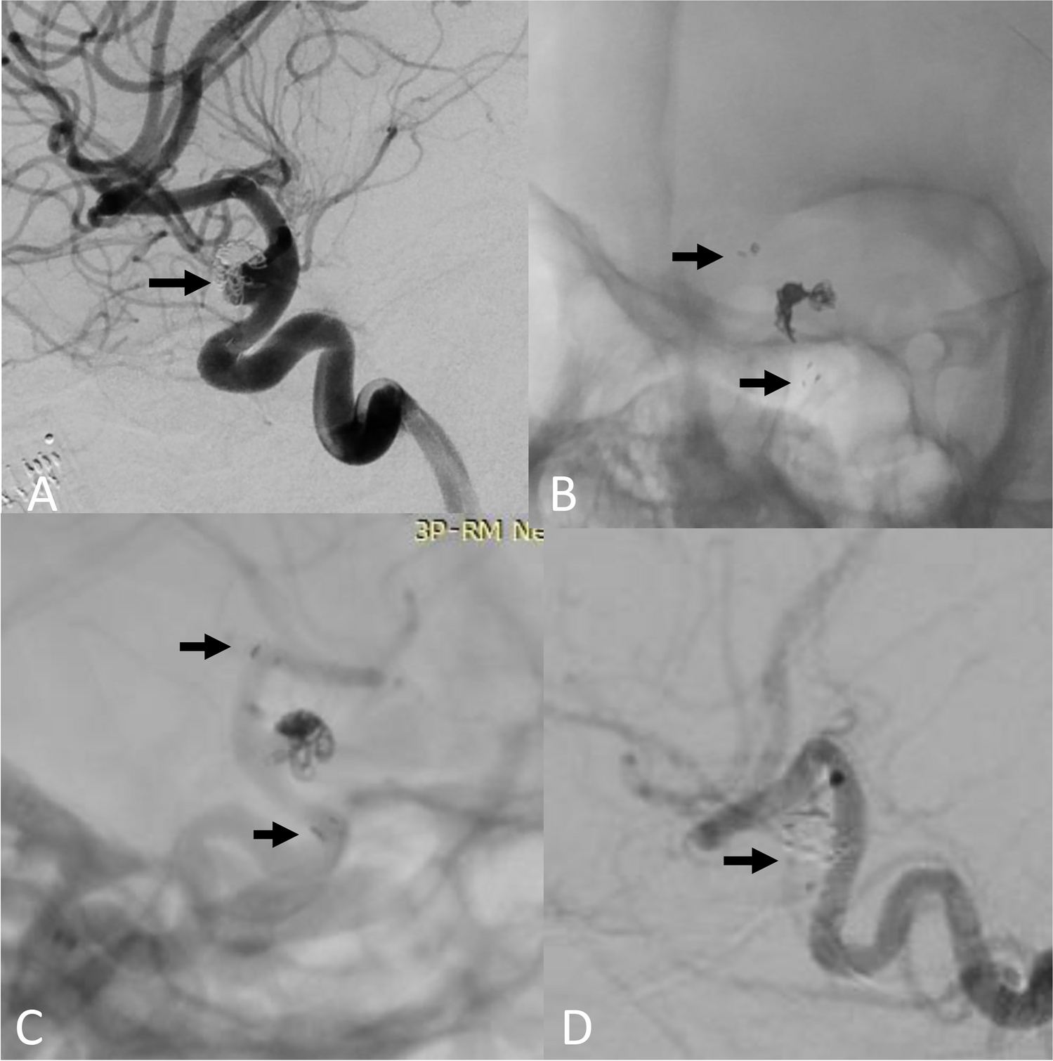 Pipeline embolization device for aneurysm recurrence after stent-assisted coiling