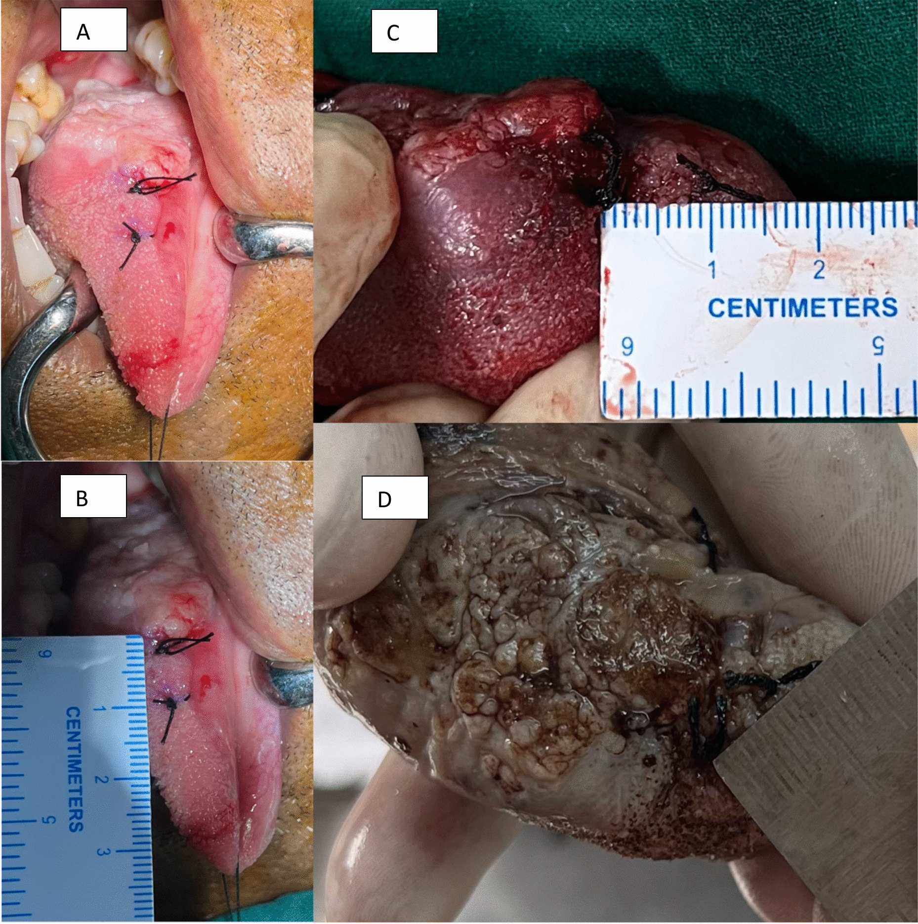 Margin Shrinkage in Oral Squamous Cell Carcinoma: A Prospective Observational Study