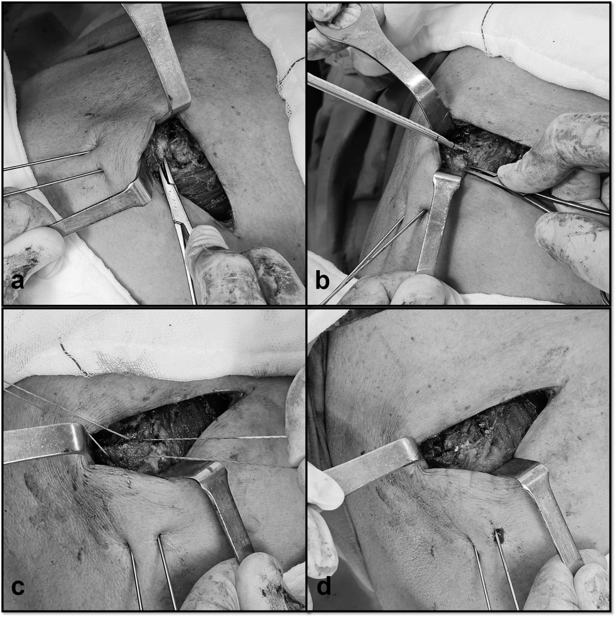 Does capsule repair improve the clinical and radiological outcomes of the acute Rockwood type V acromioclavicular dislocations treated with the double endobutton technique?