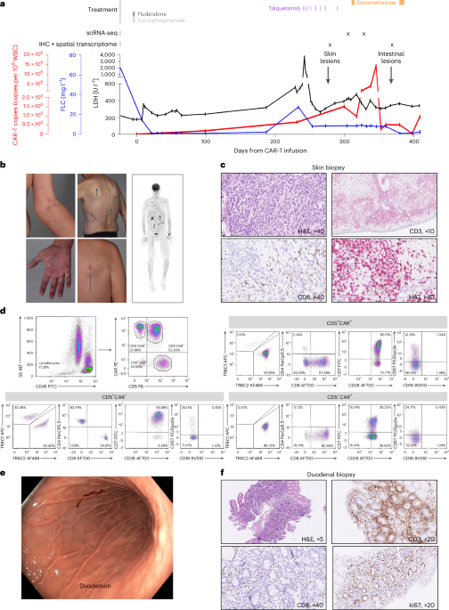 Multiomic profiling of T cell lymphoma after therapy with anti-BCMA CAR T cells and GPRC5D-directed bispecific antibody