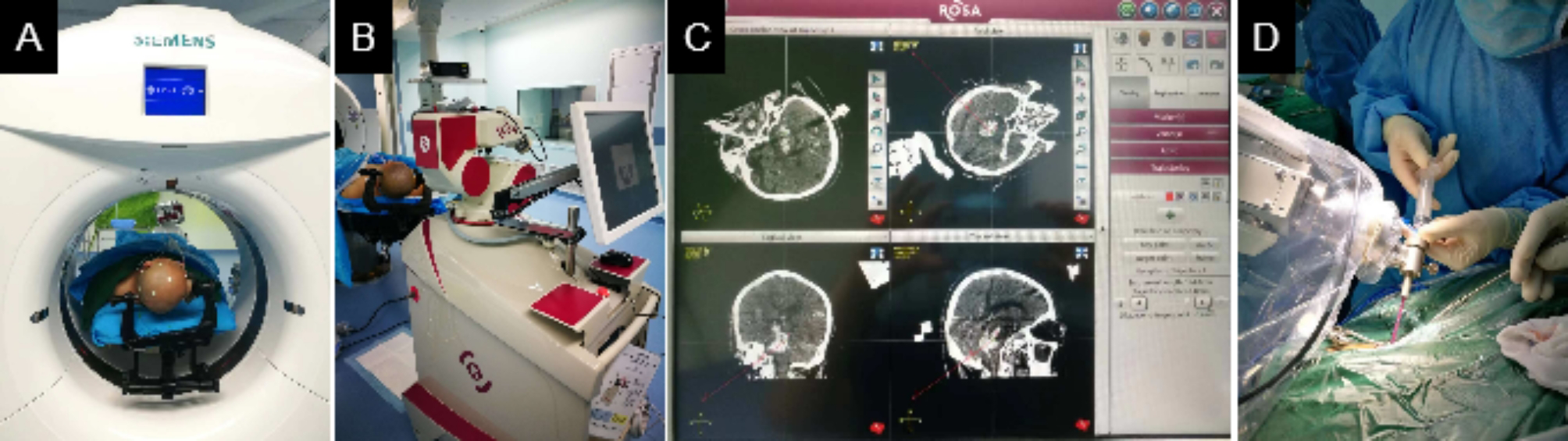 Robot-assisted puncture versus conservative treatment for severe brainstem hemorrhage: clinical outcomes comparison with experience of 138 cases in a single medical center