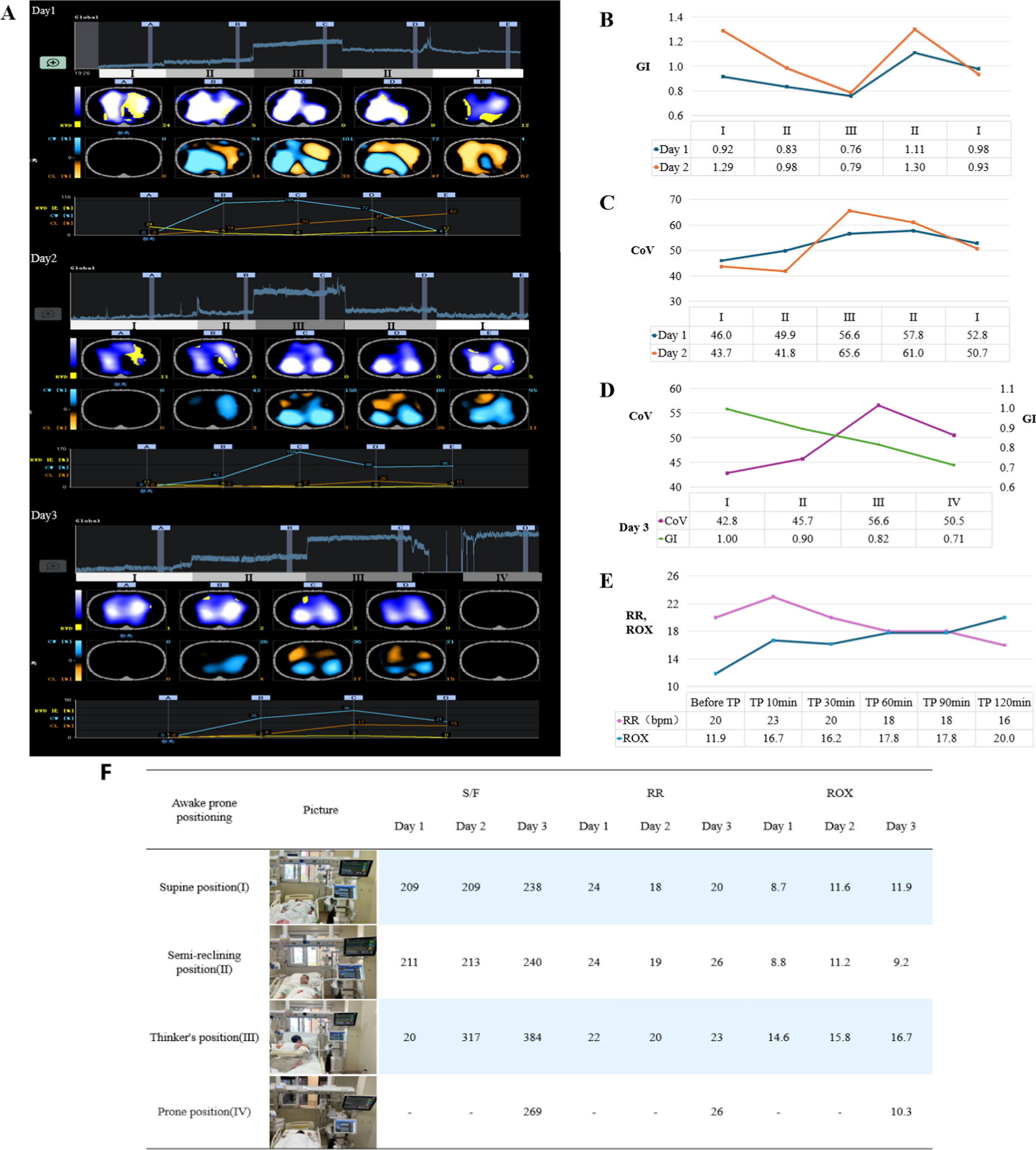 Electrical impedance tomography-guided the optimal awake prone position in a moderate ARDS patient