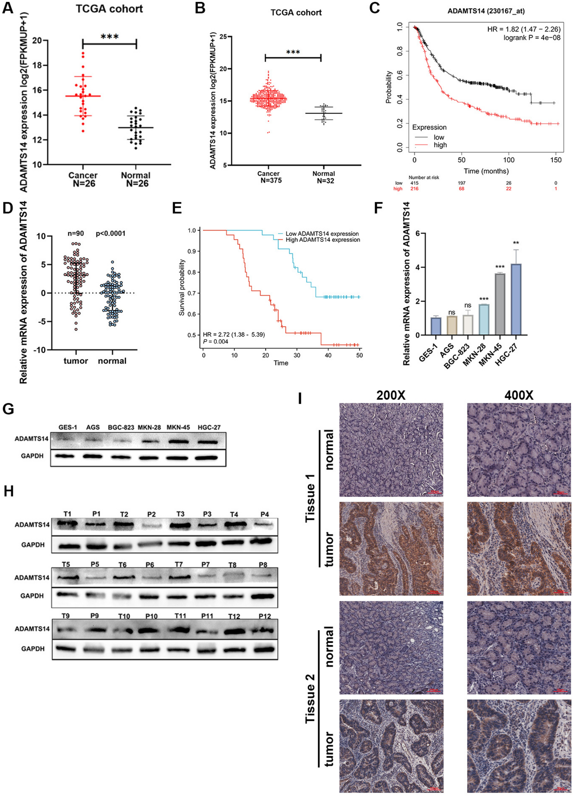 The impact of ADAMTS14 genetic polymorphisms and its function on susceptibility to and prognosis of gastric cancer in a Chinese Han population