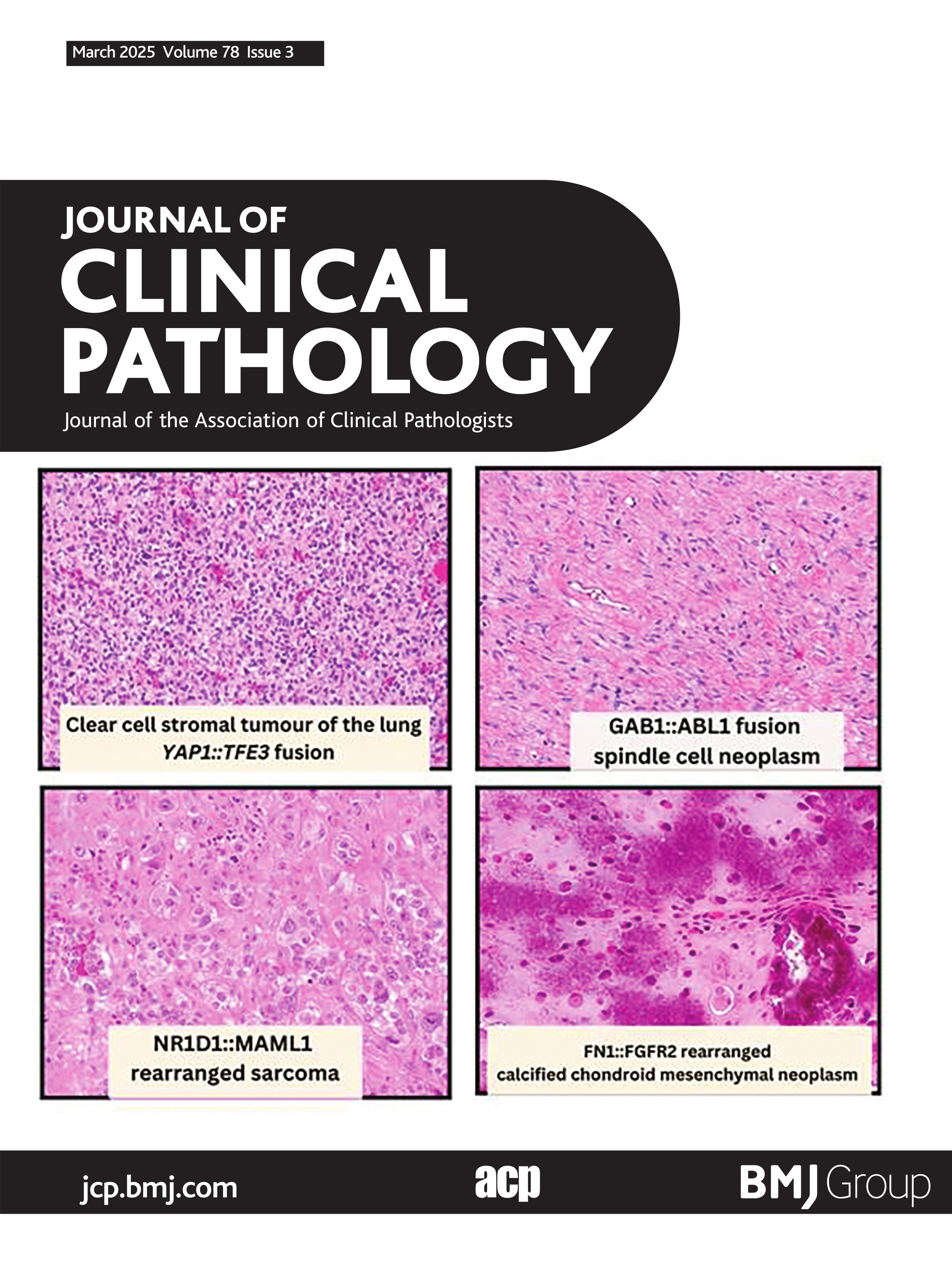 Multisite clinical cross-validation and variant interpretation of a next generation sequencing panel for lymphoid cancer prognostication