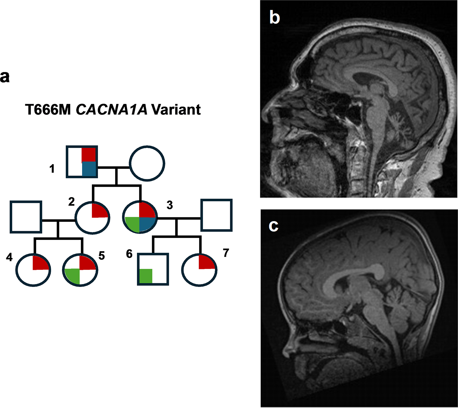 Insights on the Shared Genetic Landscape of Neurodevelopmental and Movement Disorders