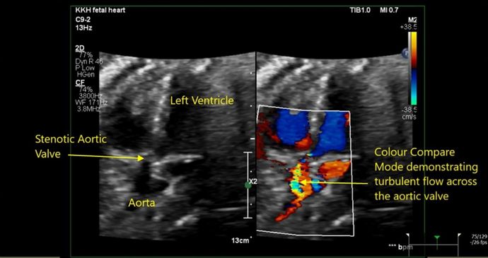 The Ethics of Fetal Cardiac Intervention