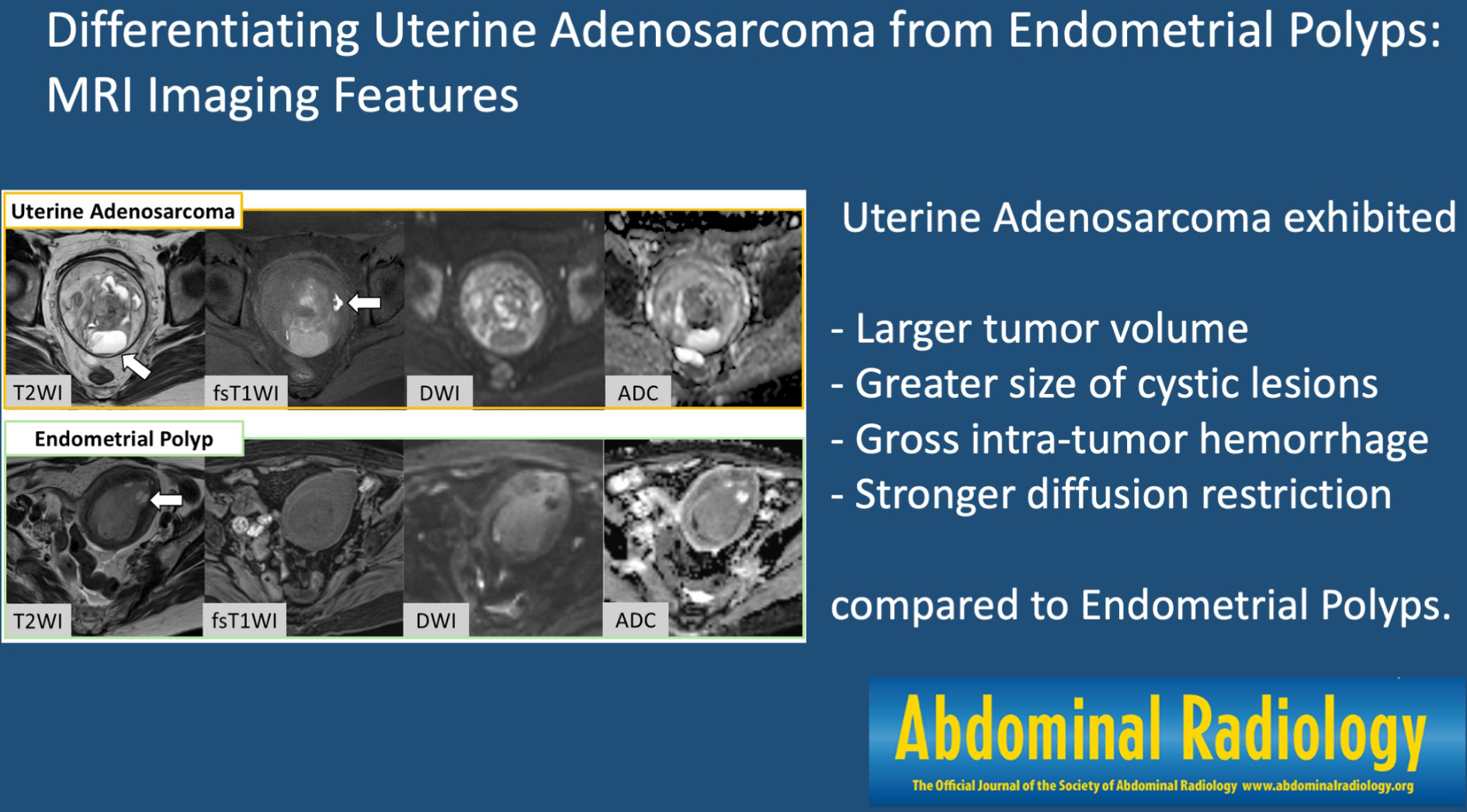 Differentiating uterine adenosarcoma from endometrial polyps: MRI imaging features