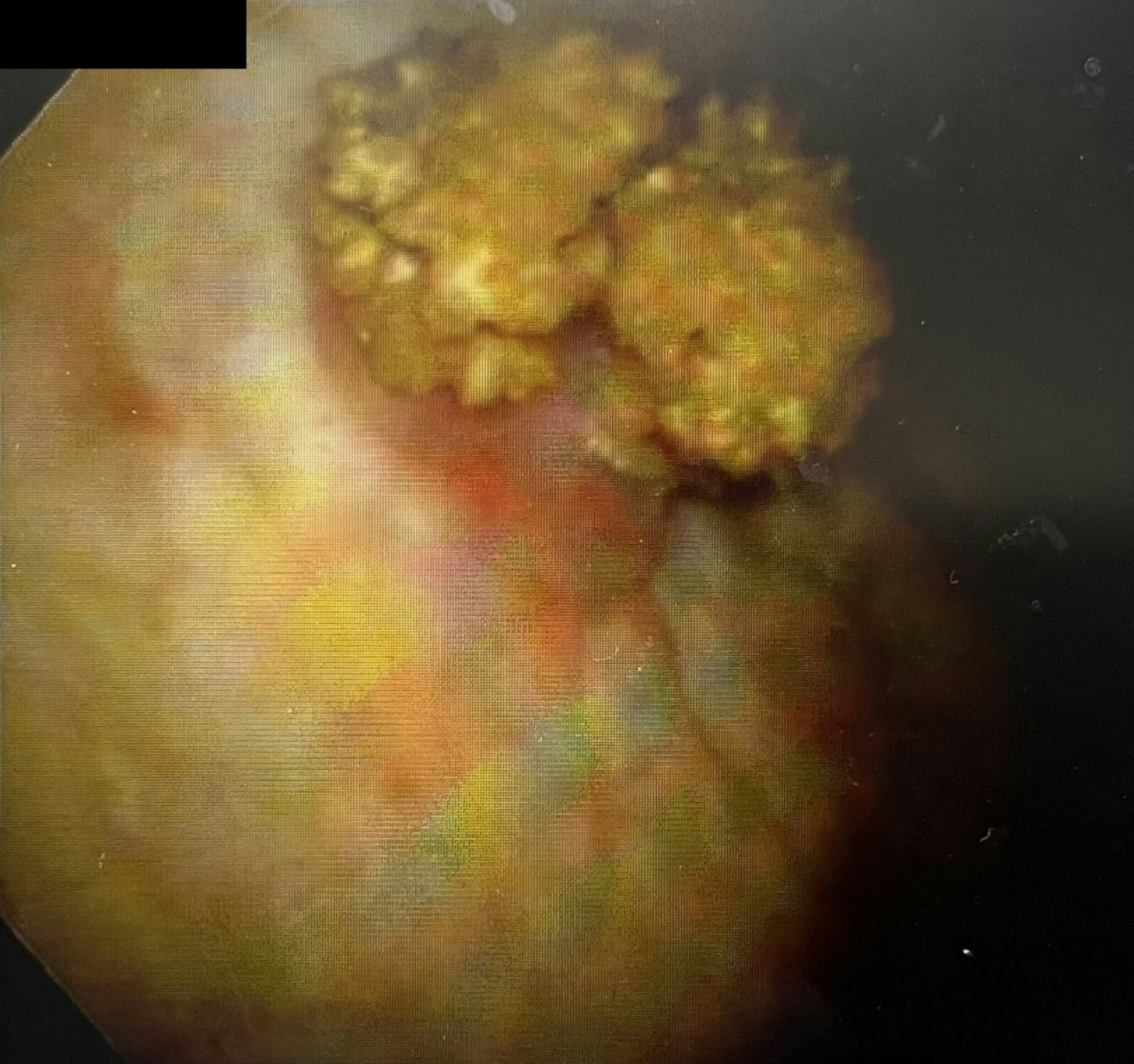 A case of plasmacytoid urothelial carcinoma with characteristic radiological findings