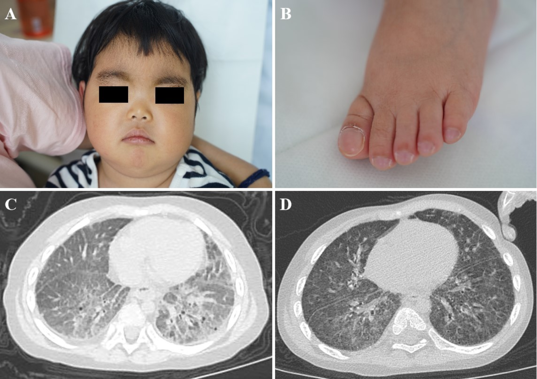 Interstitial Lung Disease in a Girl with Prolidase Deficiency