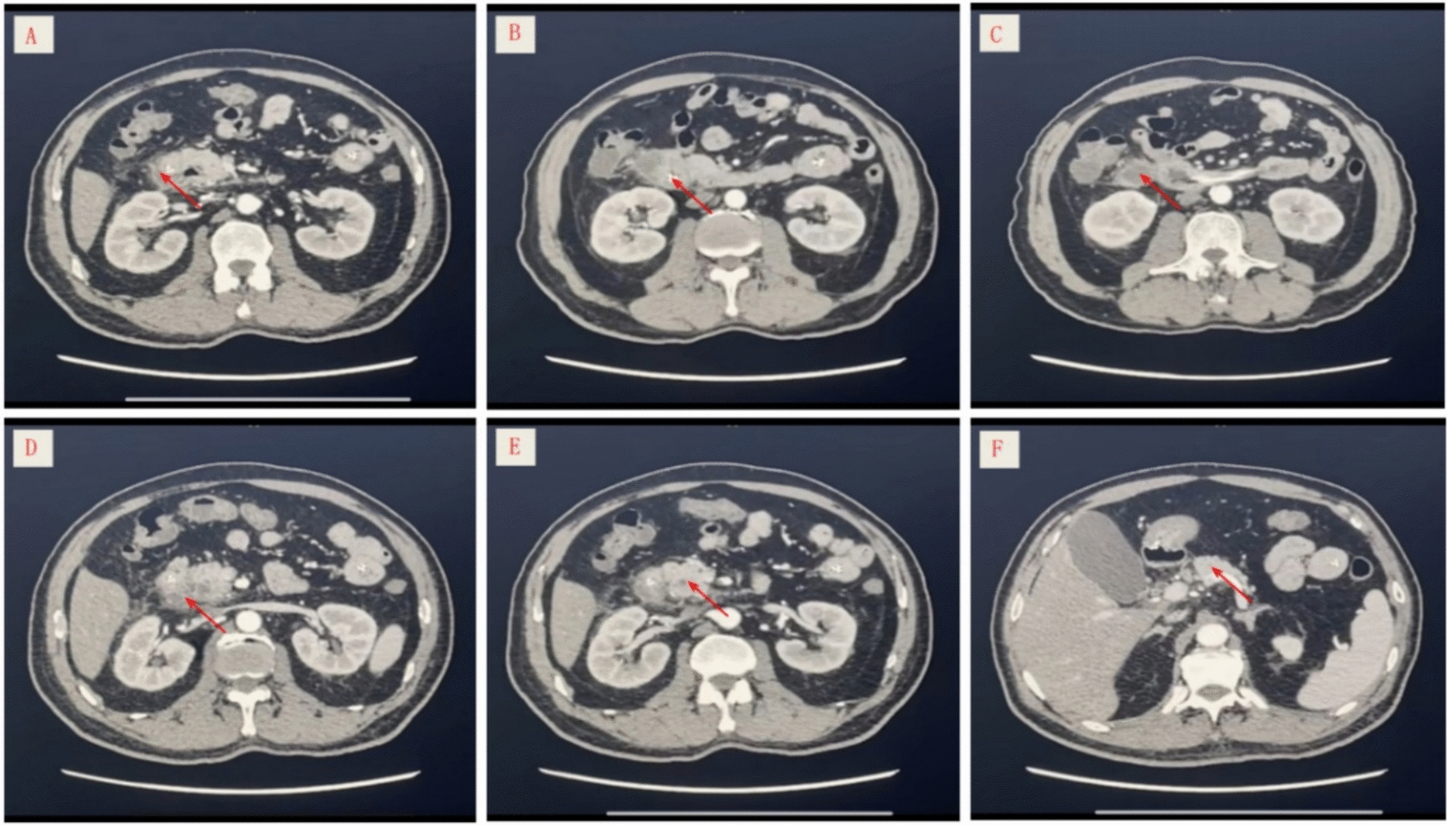Simple Groove Pancreatitis: A Case Report of Diagnosis and Conservative Management