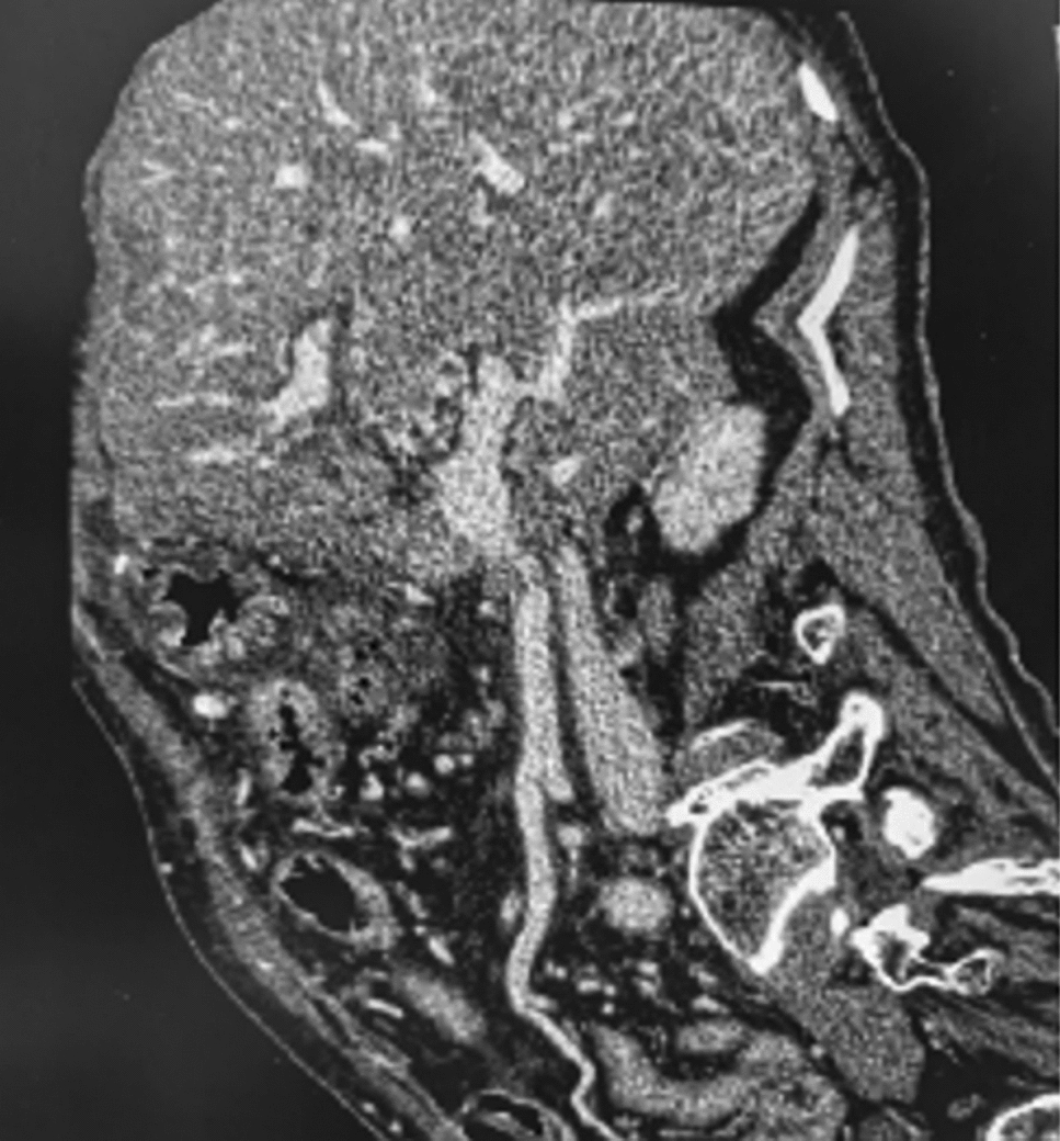 Regional Portal Hypertension Related to Pancreatic Cancer Surgery