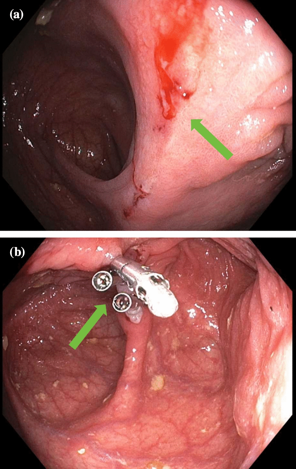 Endoscopic Therapy for Anastomotic Bleeding in Inflammatory Bowel Disease