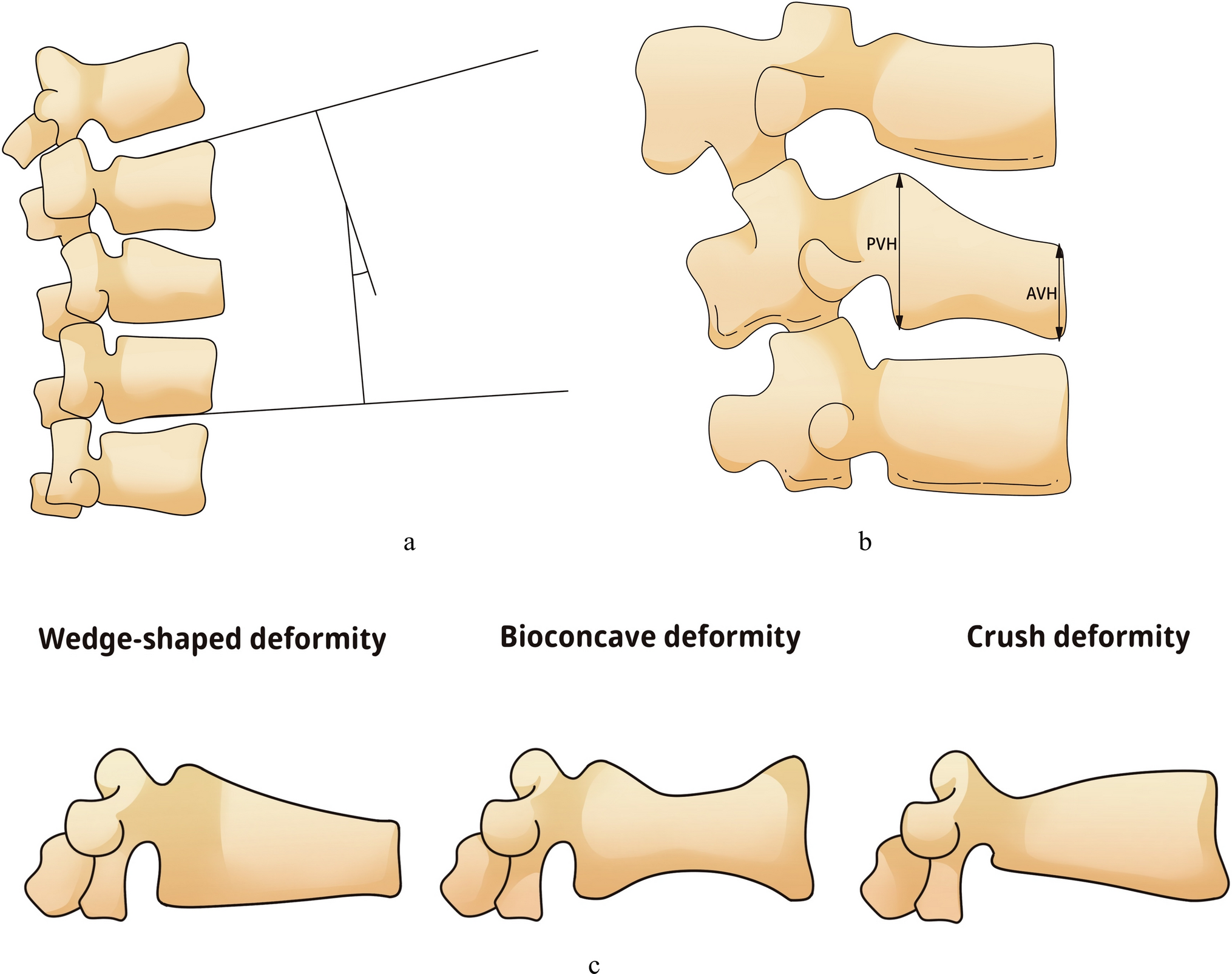 Predictive factors associated with the onset of Kummell’s disease