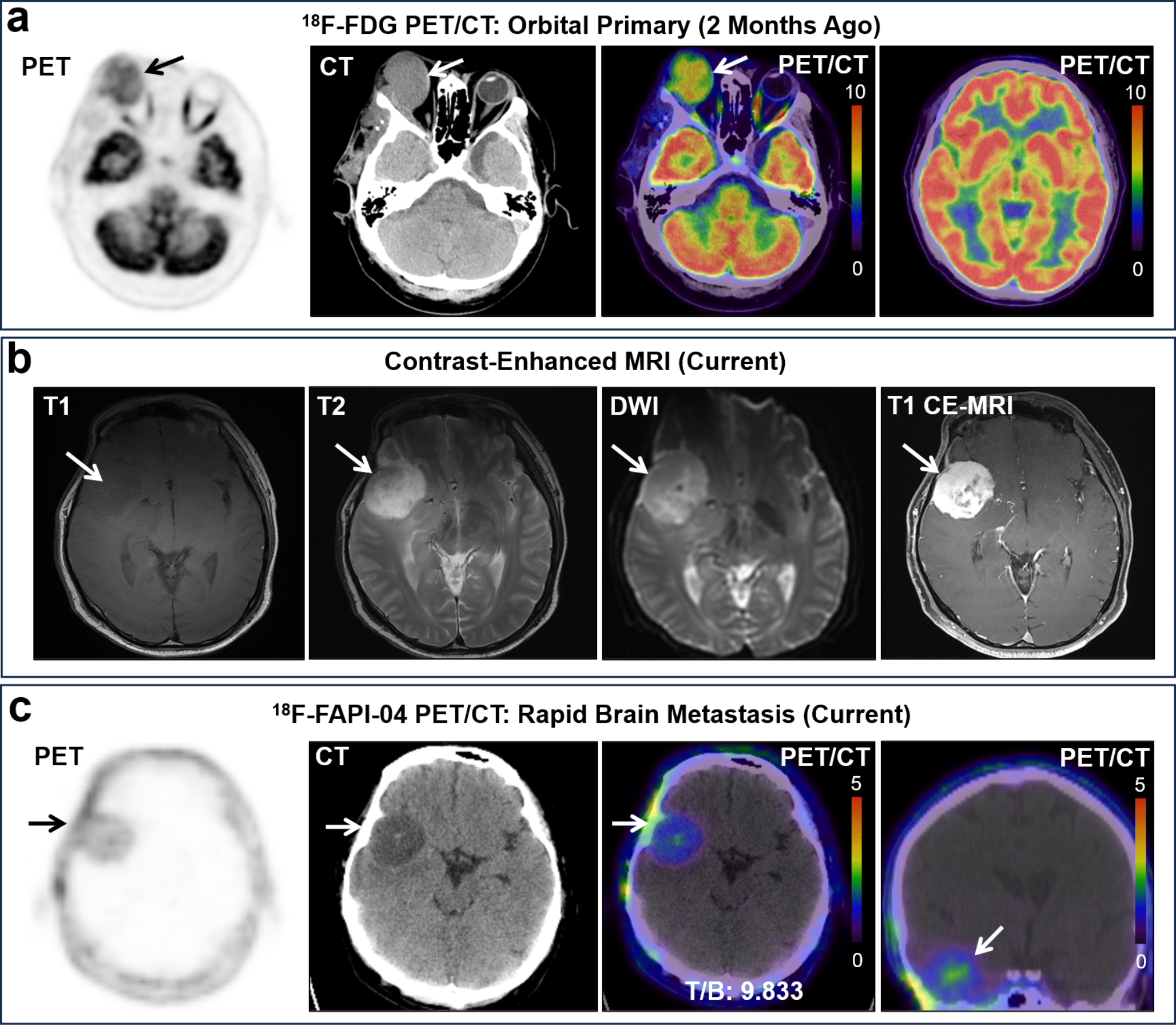 F-FAPI-04 PET/CT Imaging of Rare Brain Metastasis from Myxoid Pleomorphic Liposarcoma