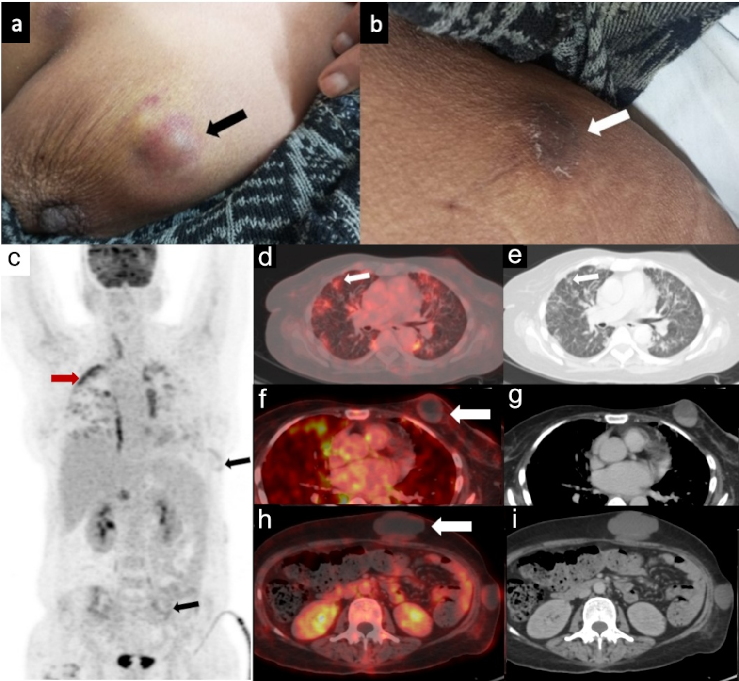 A Rare Presentation of Synchronous Pneumocystis Pneumonia and Cutaneous Nocardiosis on F-FDG PET/CT