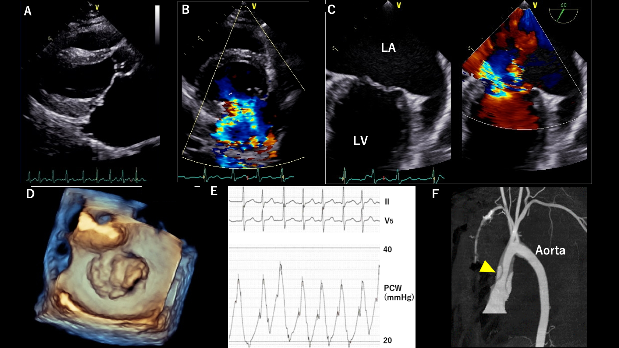 Severe mitral regurgitation with coexisting giant left atrium in a patient with Williams syndrome