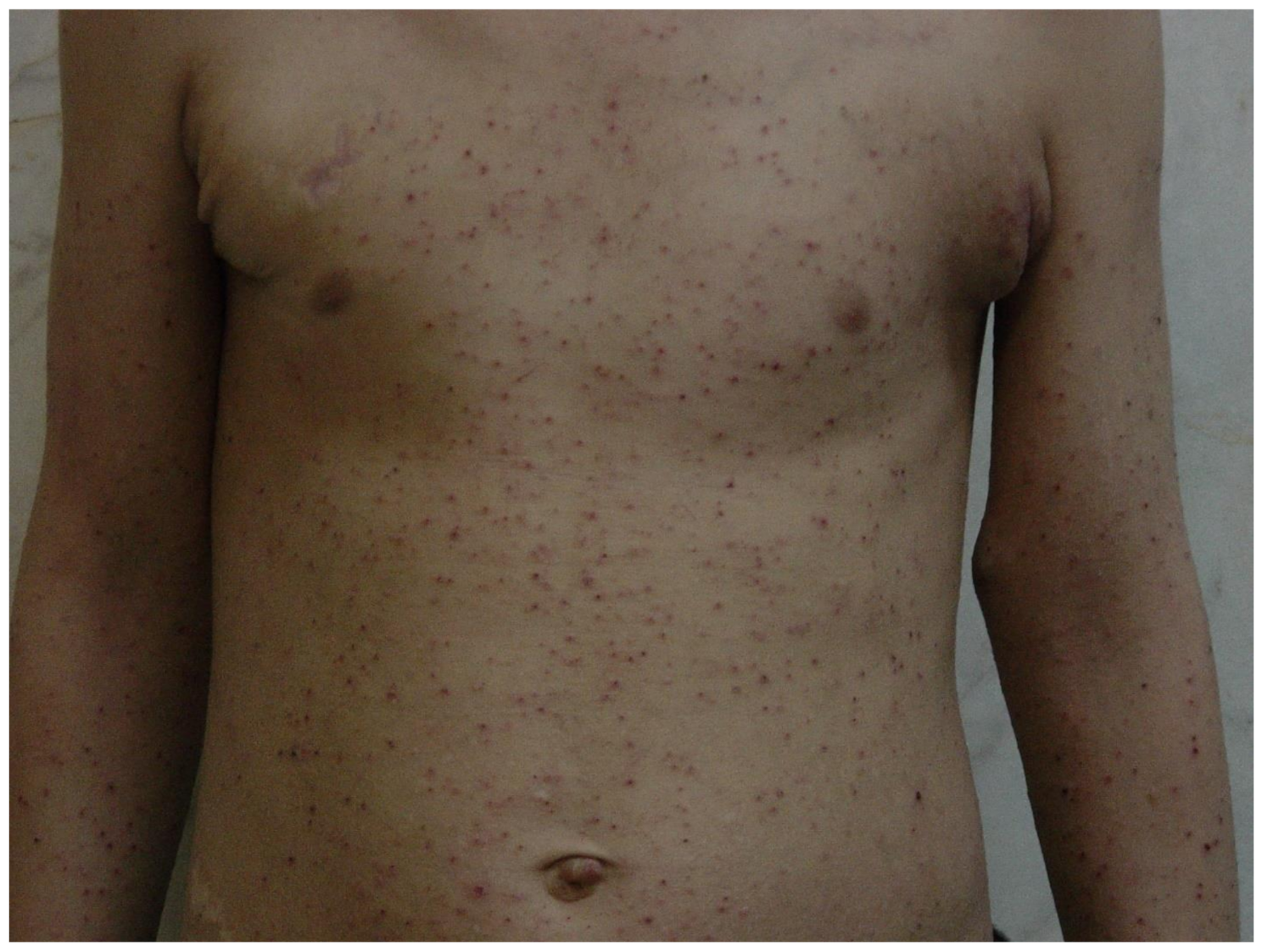 Dermatologic presentations of hyper IgE syndrome in pediatric patients