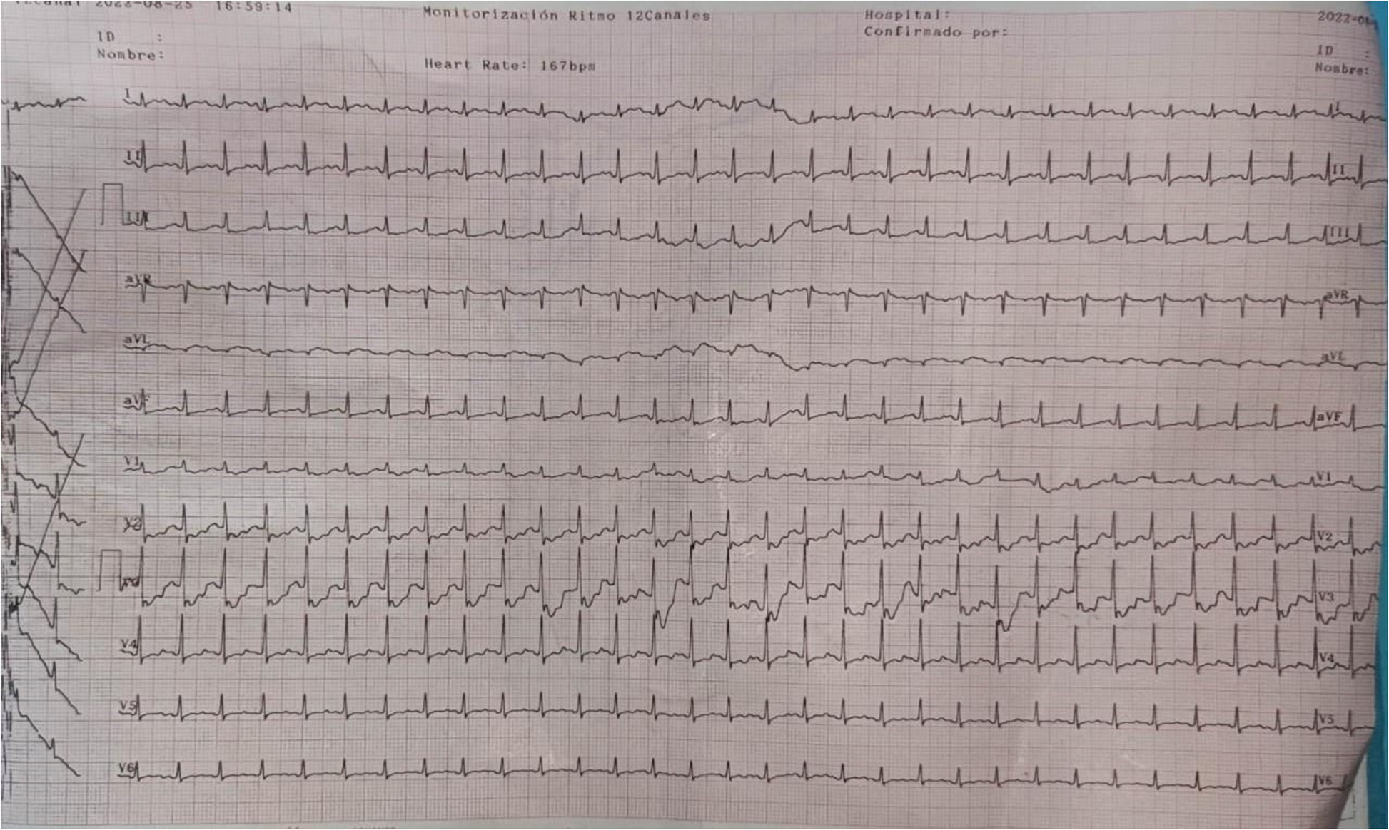 Cardiovascular evaluation in children with acute moderate to severe malnutrition