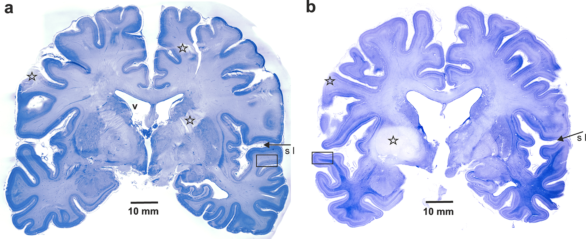 Histo- and cytopathological findings in the brain of two fire fatalities