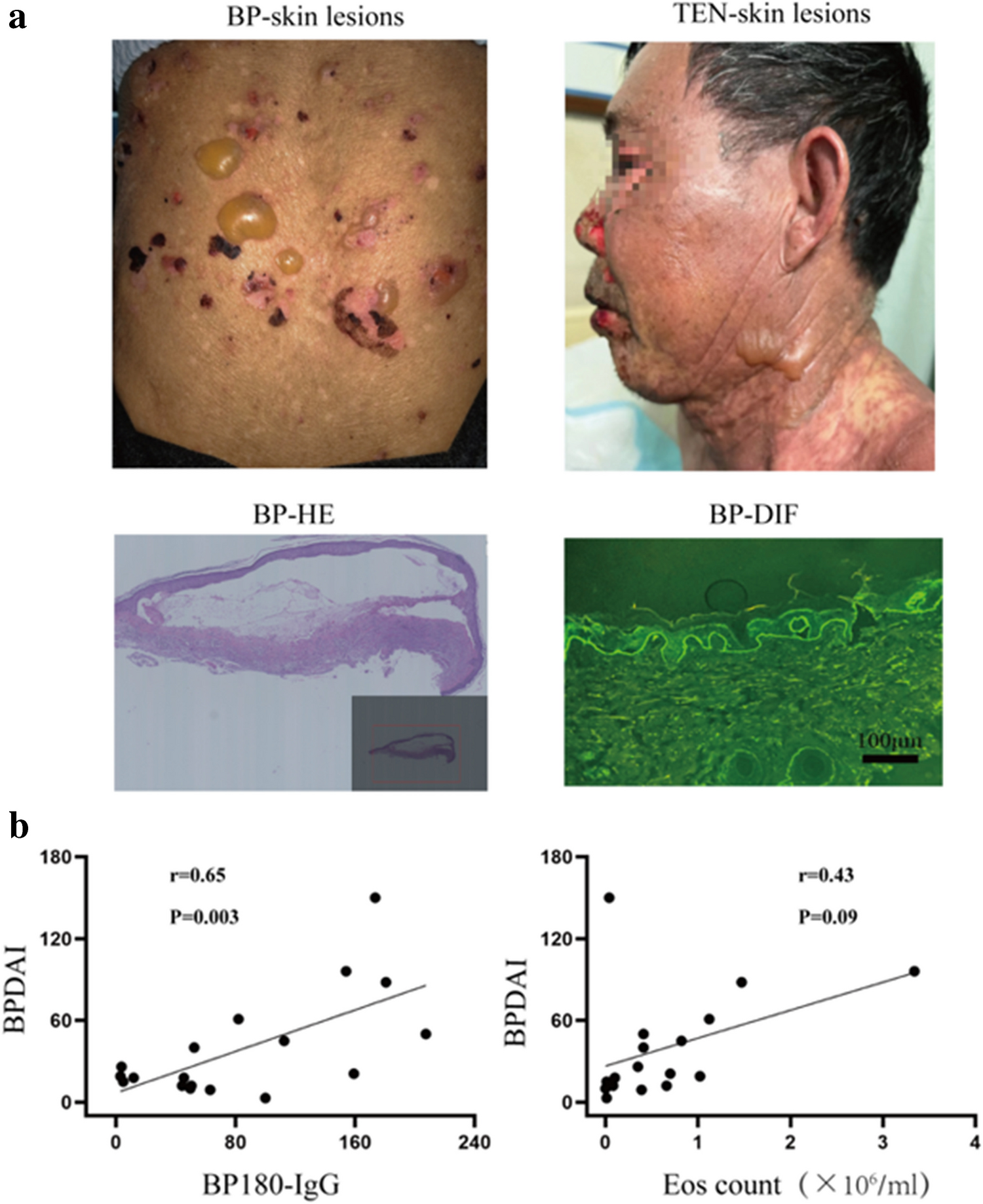 Role of basophils and type 2 inflammation in bullous pemphigoid pathophysiology: a comparative study of blood and blister fluid