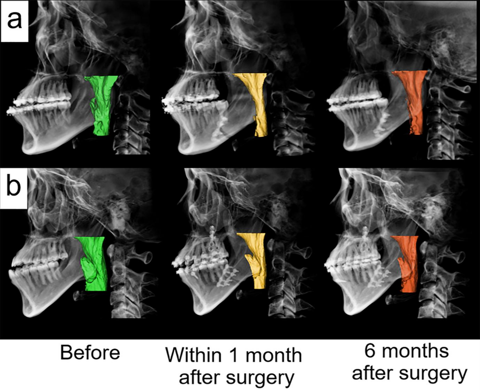 Effects of mandibular setback surgery using the surgery-first approach versus conventional orthognathic approach on upper airway change and sleep quality
