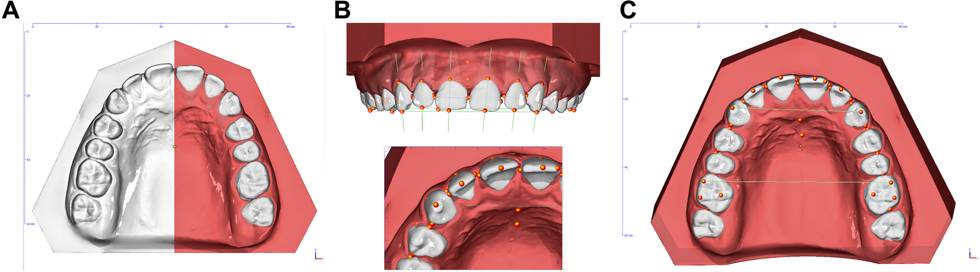 Validation of a digital, partly automated three-dimensional cast analysis for evaluation of orthodontic treatment assessment