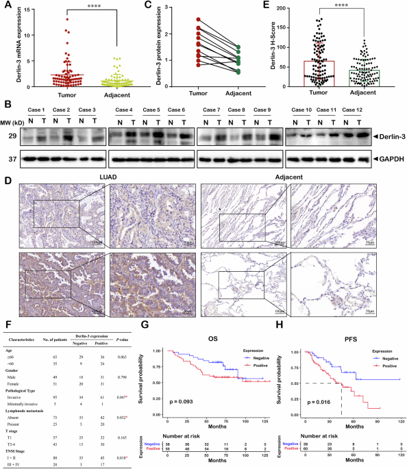 Derlin-3 manipulates the endoplasmic reticulum stress and IgG4 secretion of plasma cells in lung adenocarcinoma