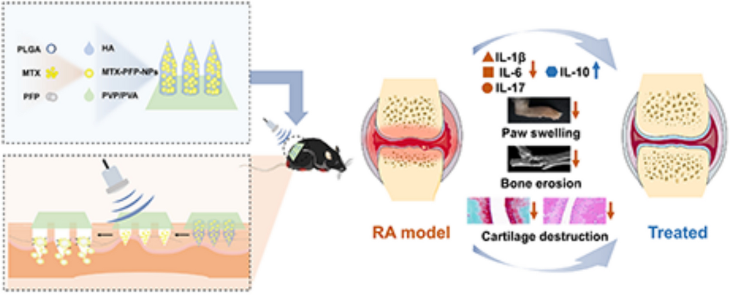 Synergy of dissolving microneedles and ultrasound to enhance transdermal delivery for rheumatoid arthritis