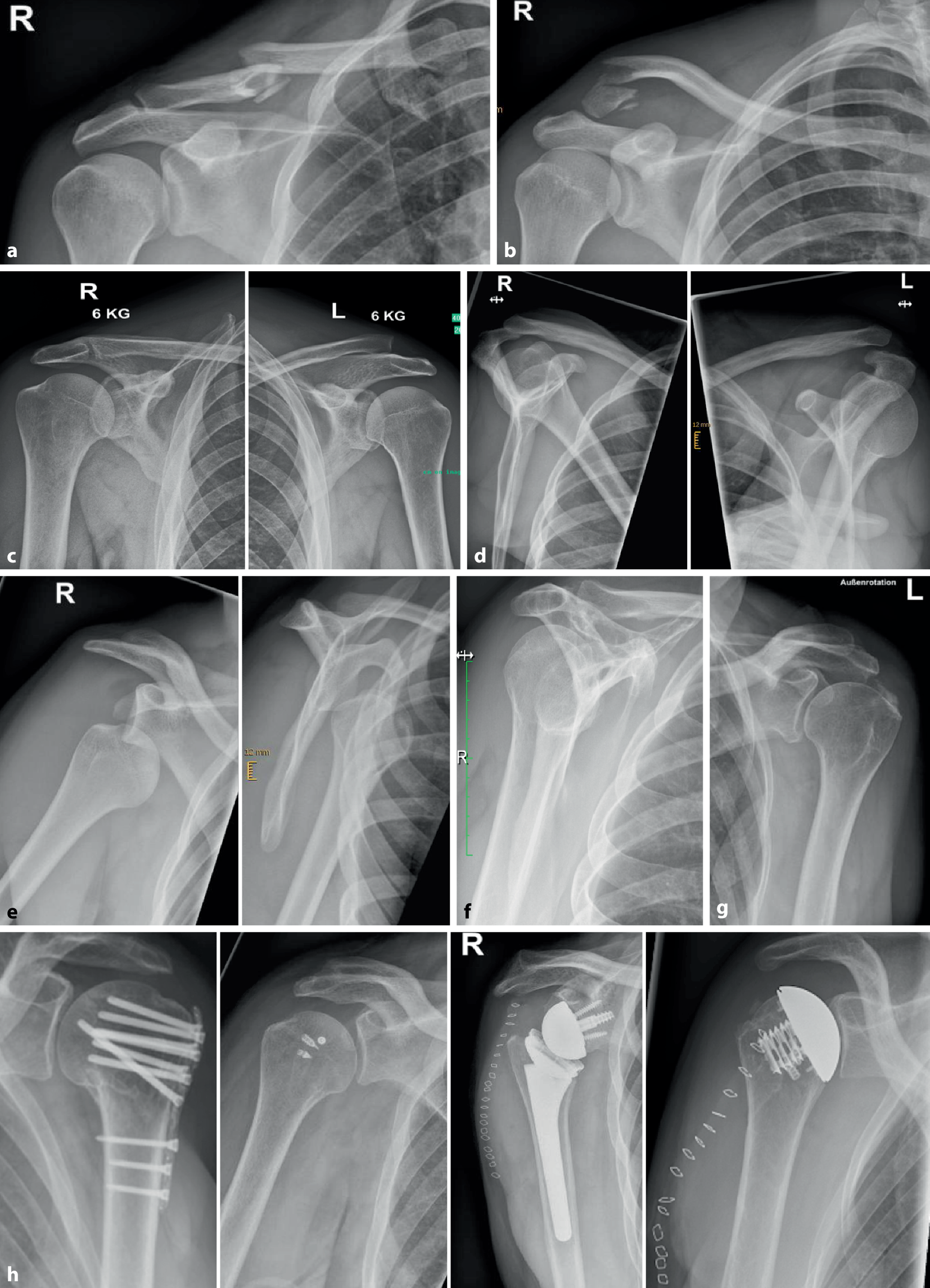 Röntgen und Computertomographie am Schulter- und Ellenbogengelenk